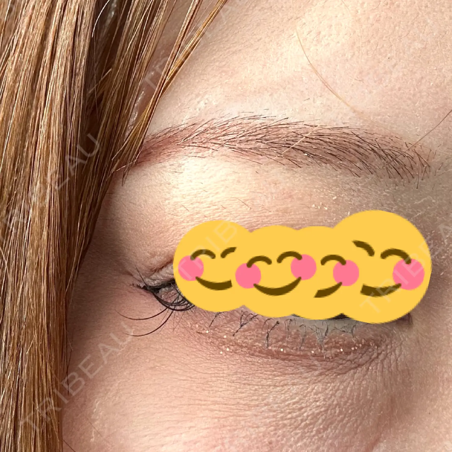 施術後の写真