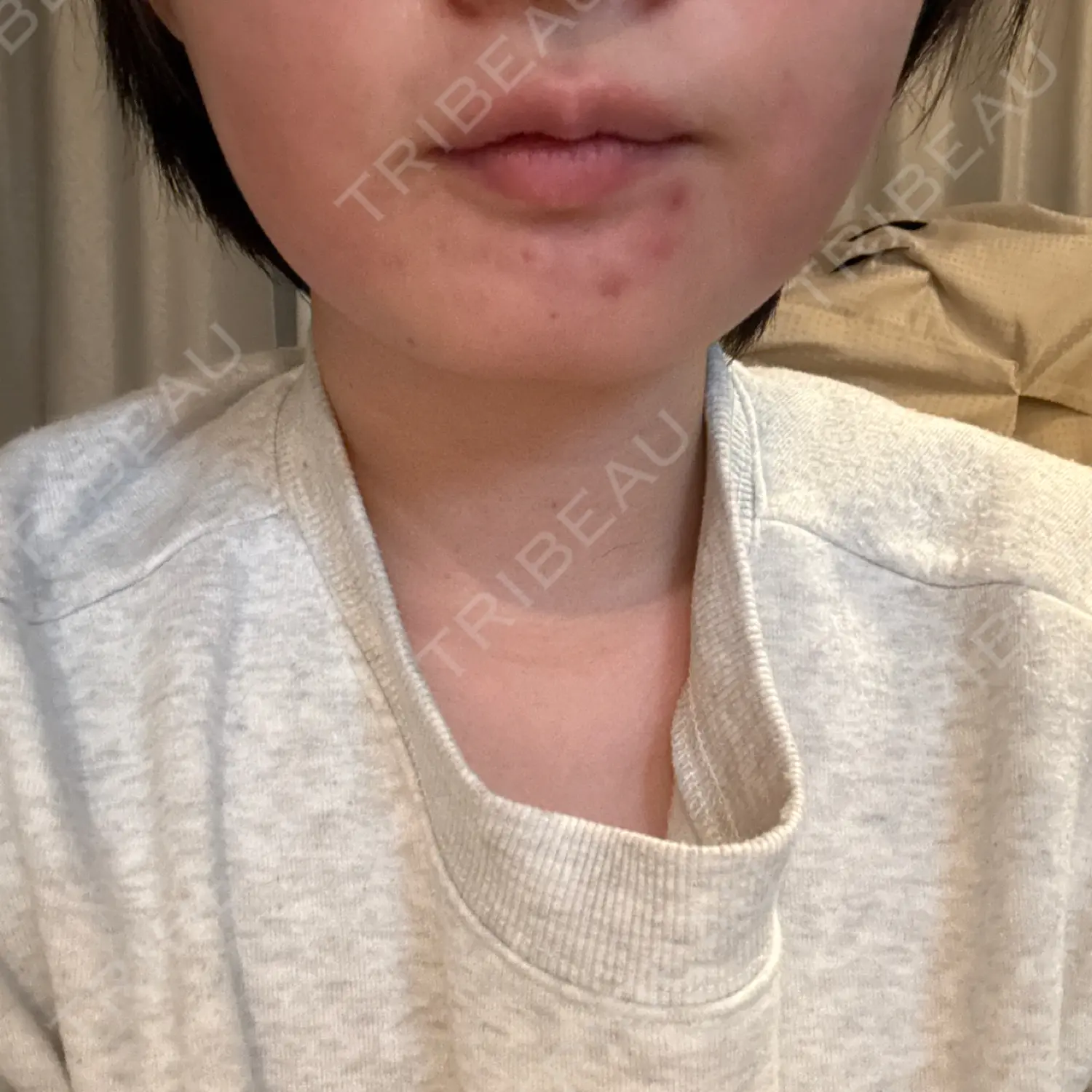 施術後の写真