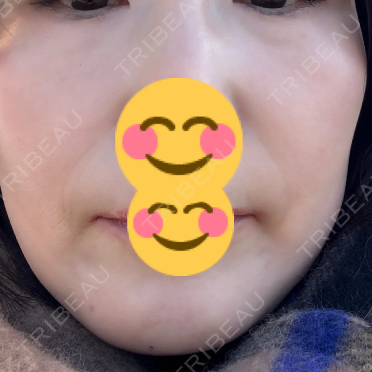 施術後の写真