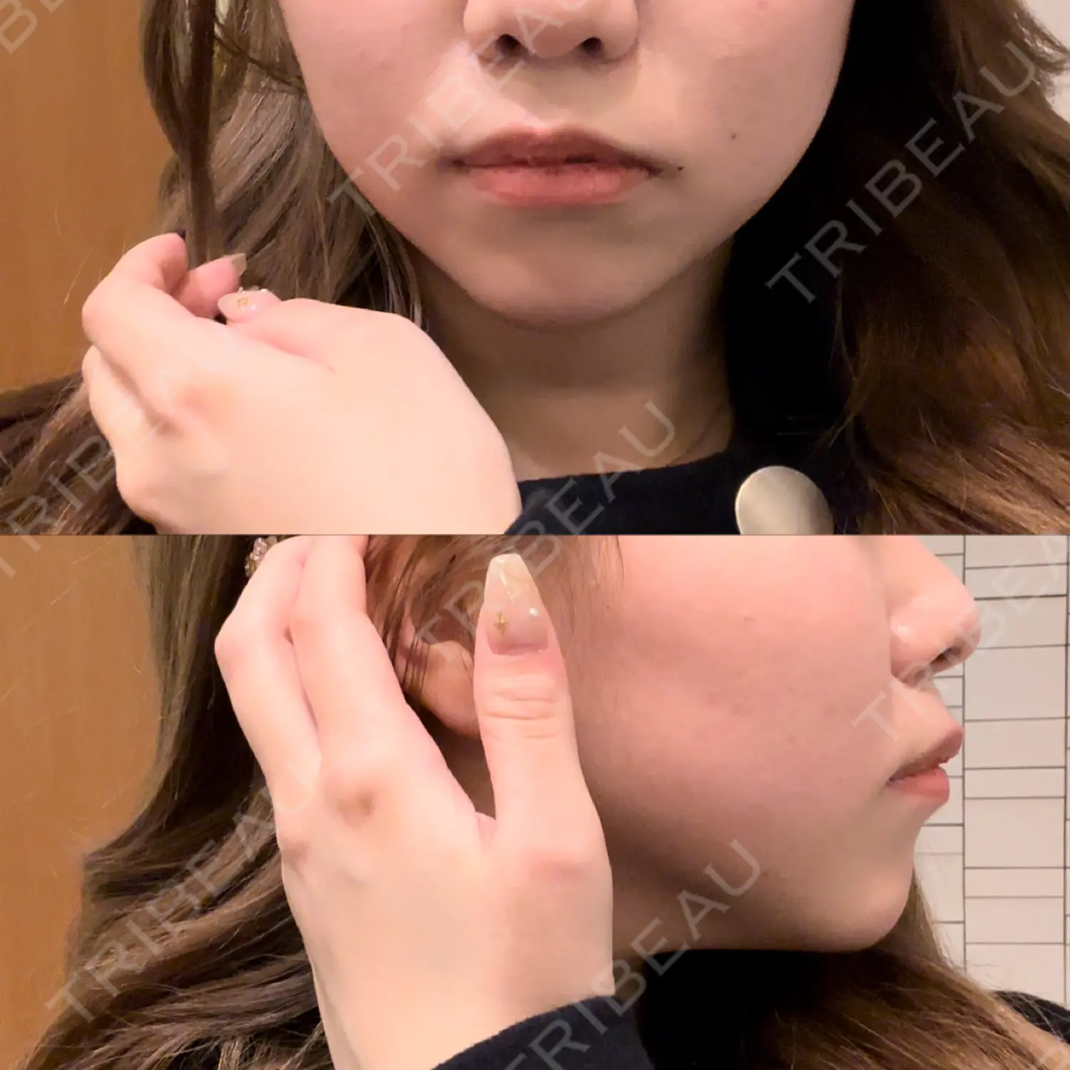 施術後の写真