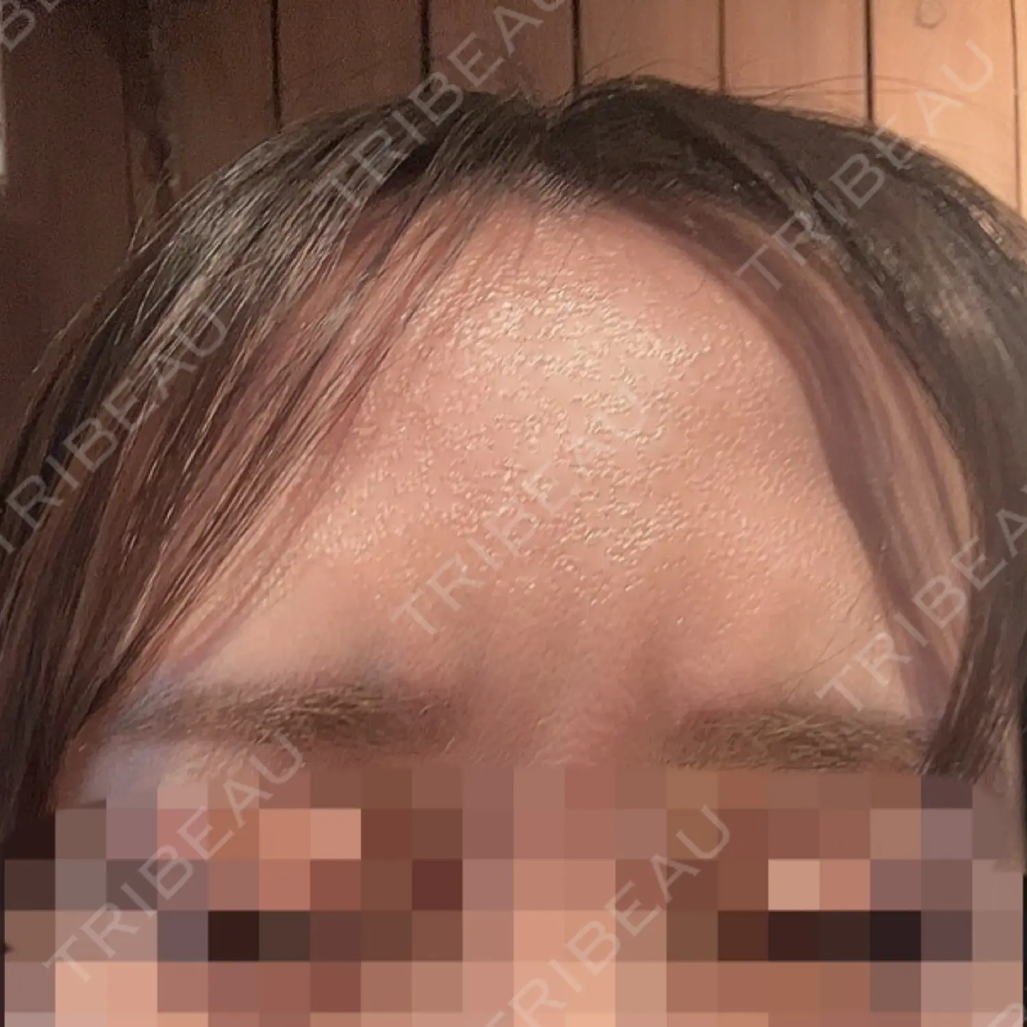 施術後の写真