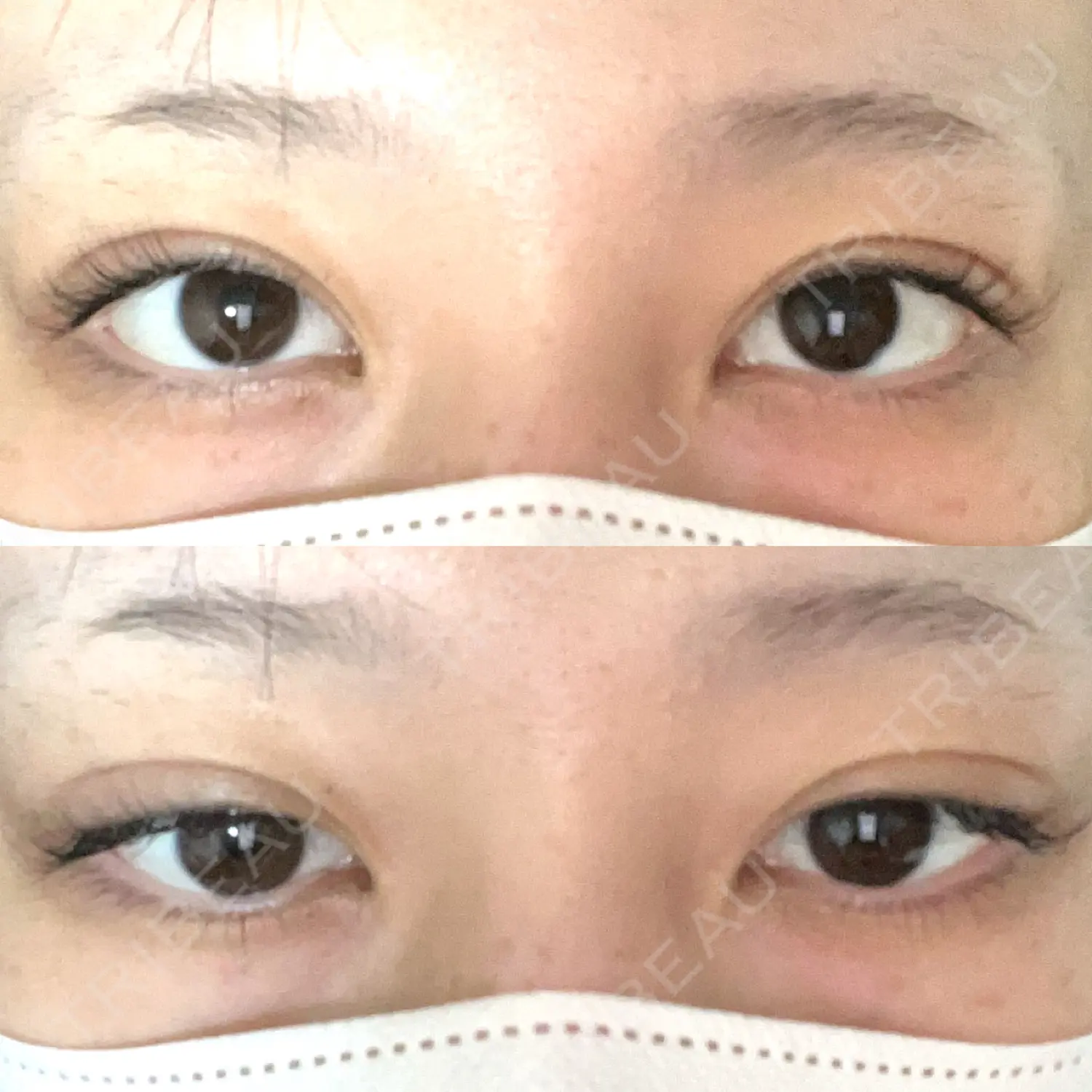 施術後の写真