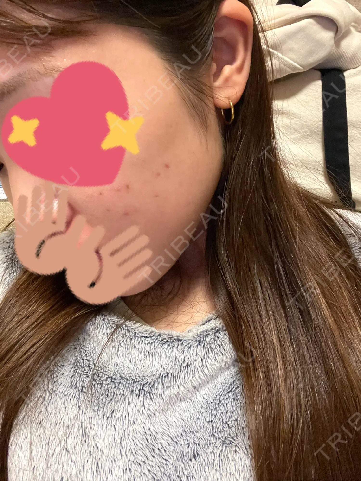 施術後の写真