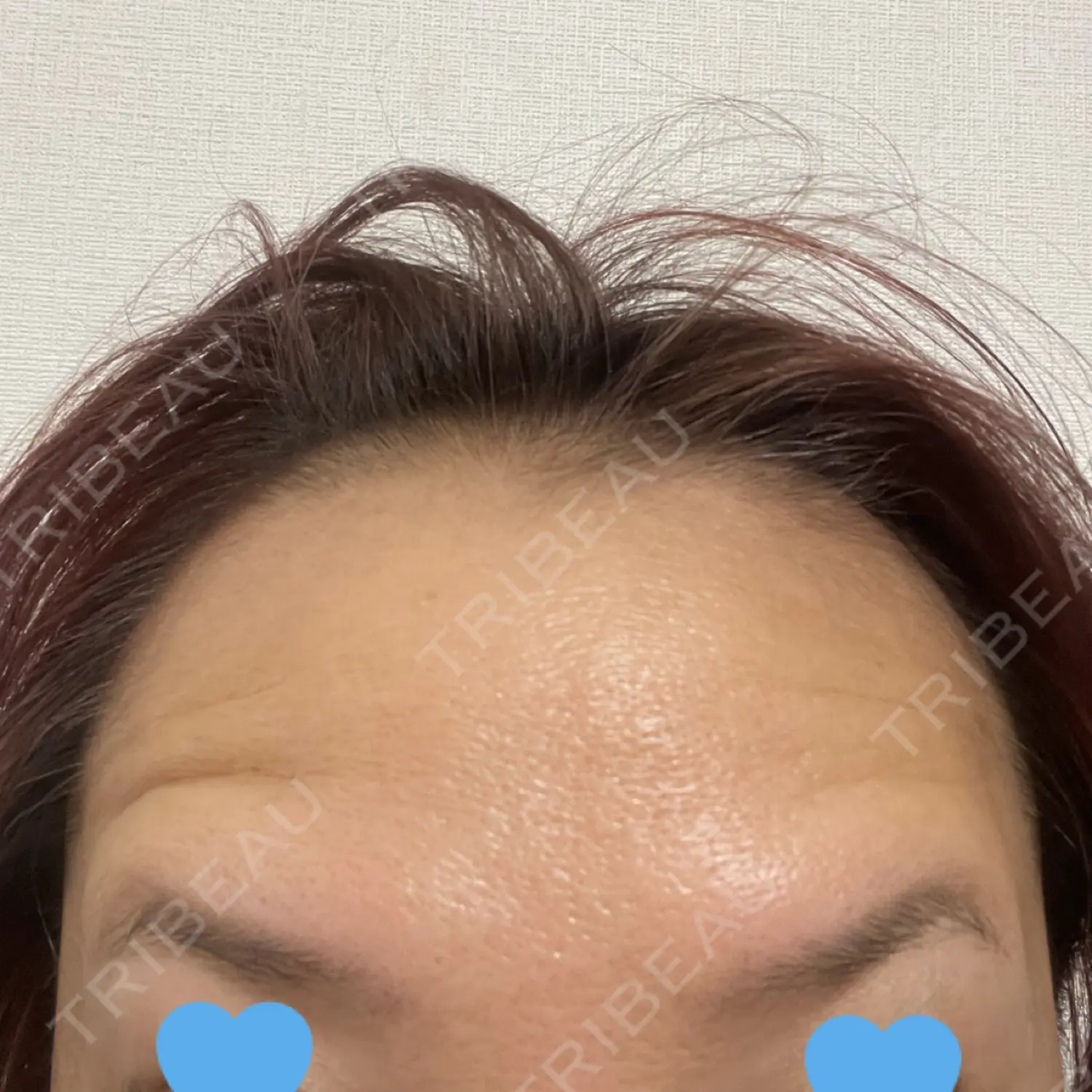 施術後の写真