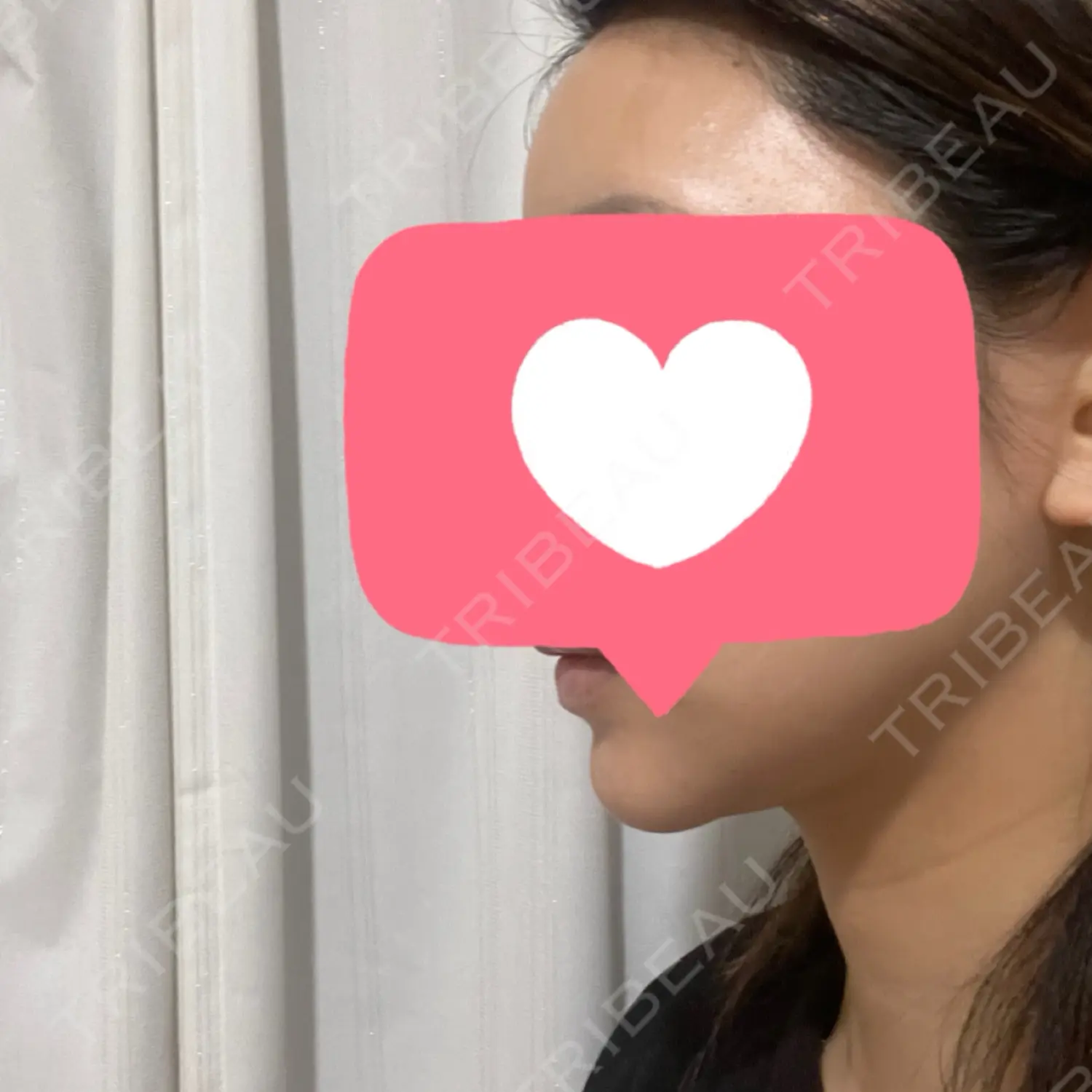 施術後の写真