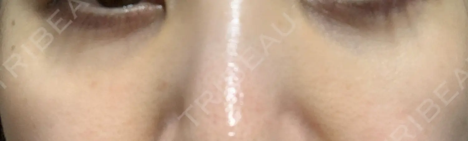 施術後の写真