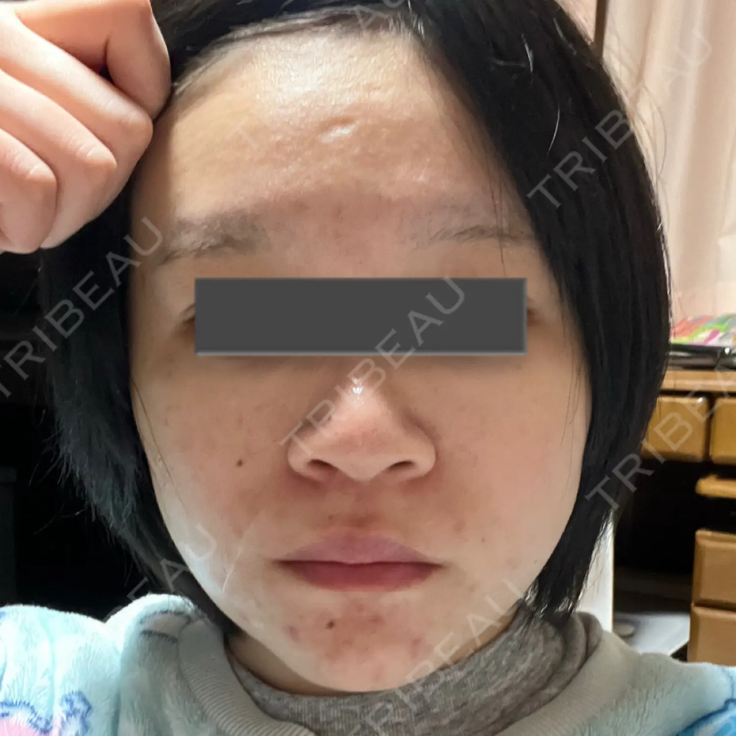 施術後の写真