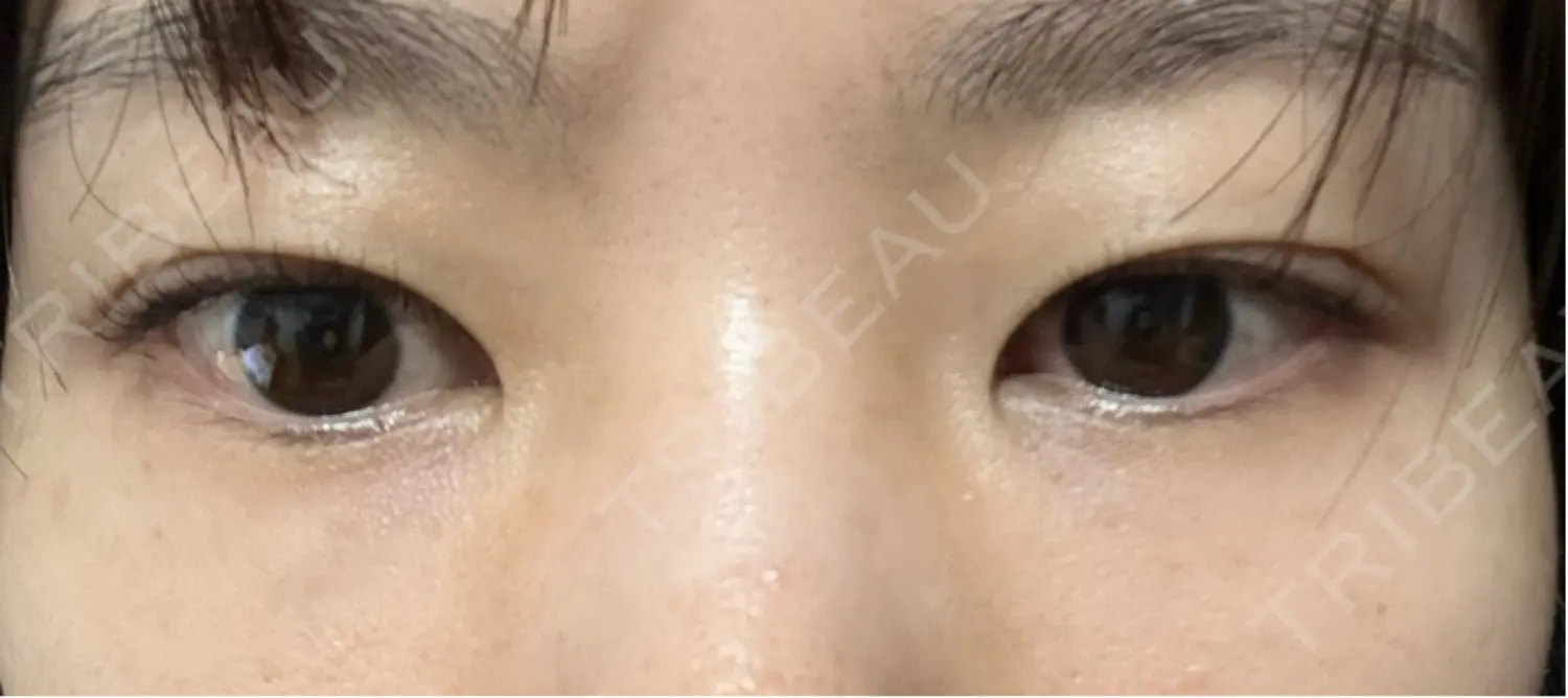 施術後の写真