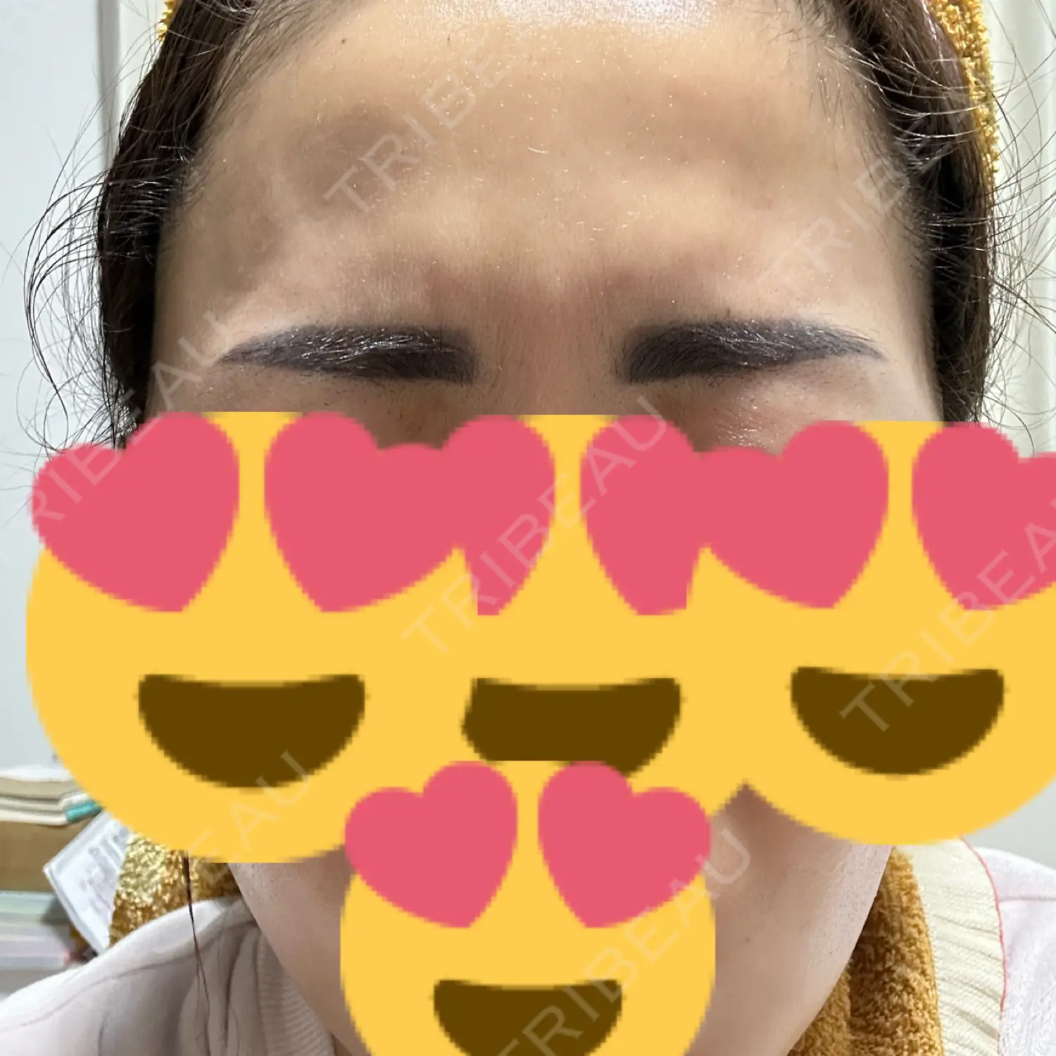 施術後の写真
