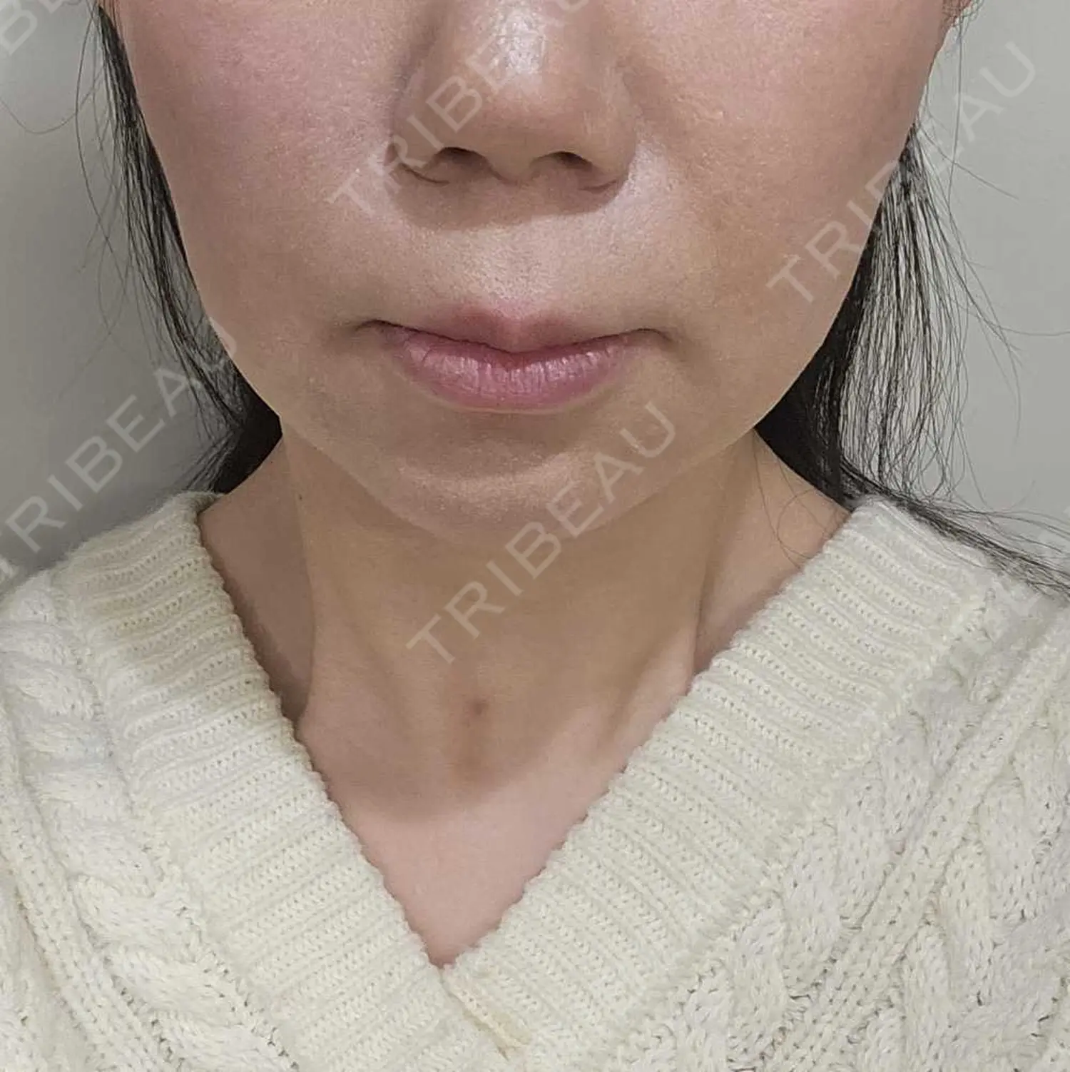 施術後の写真