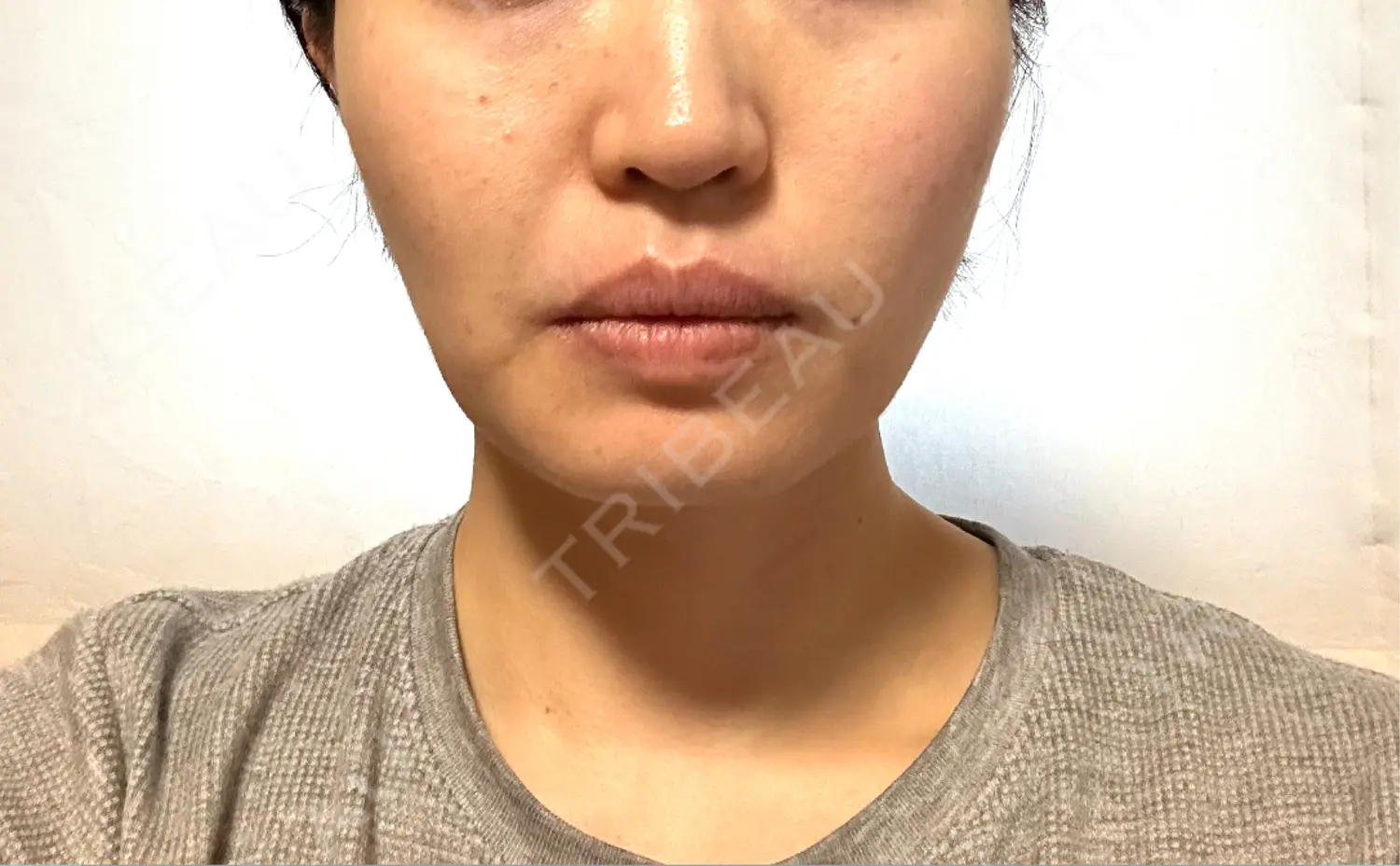 施術後の写真