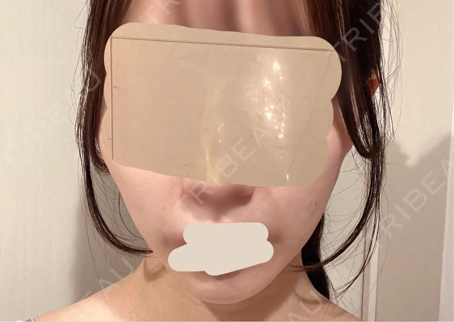 施術後の写真
