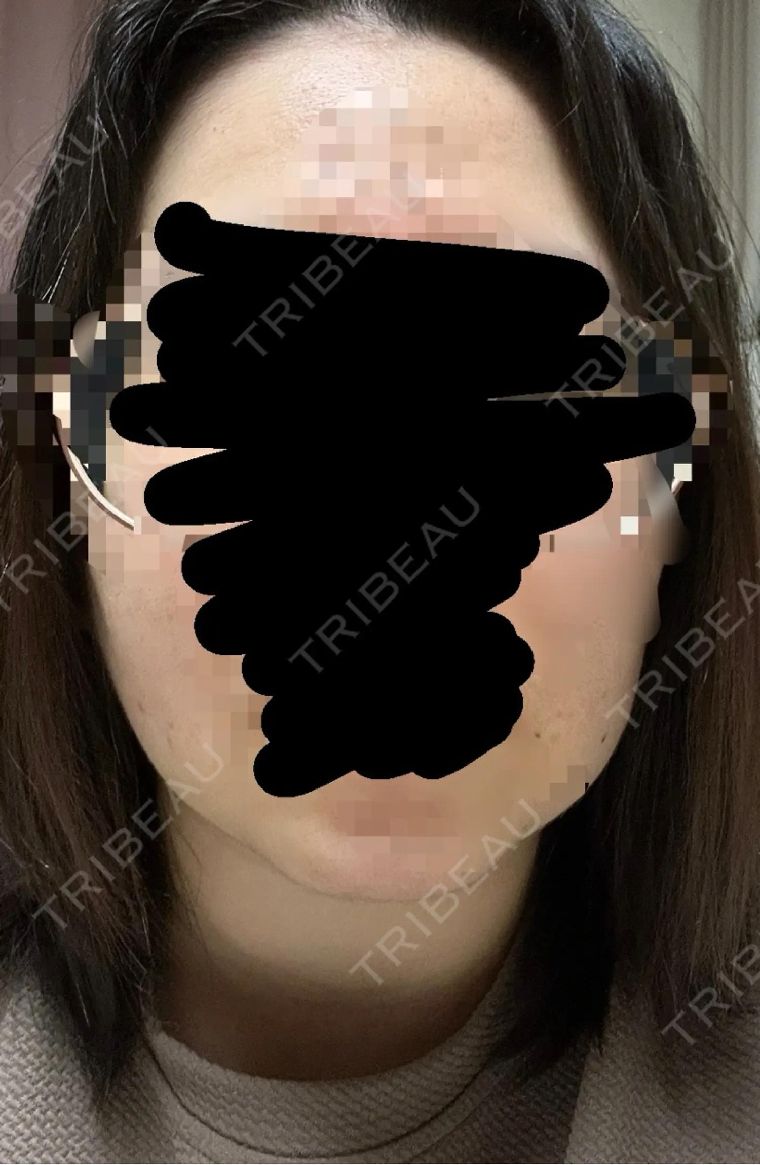 施術後の写真