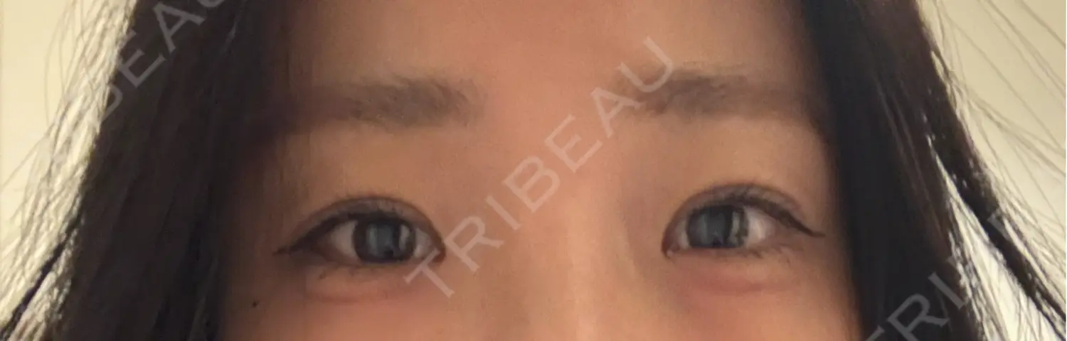 施術後の写真