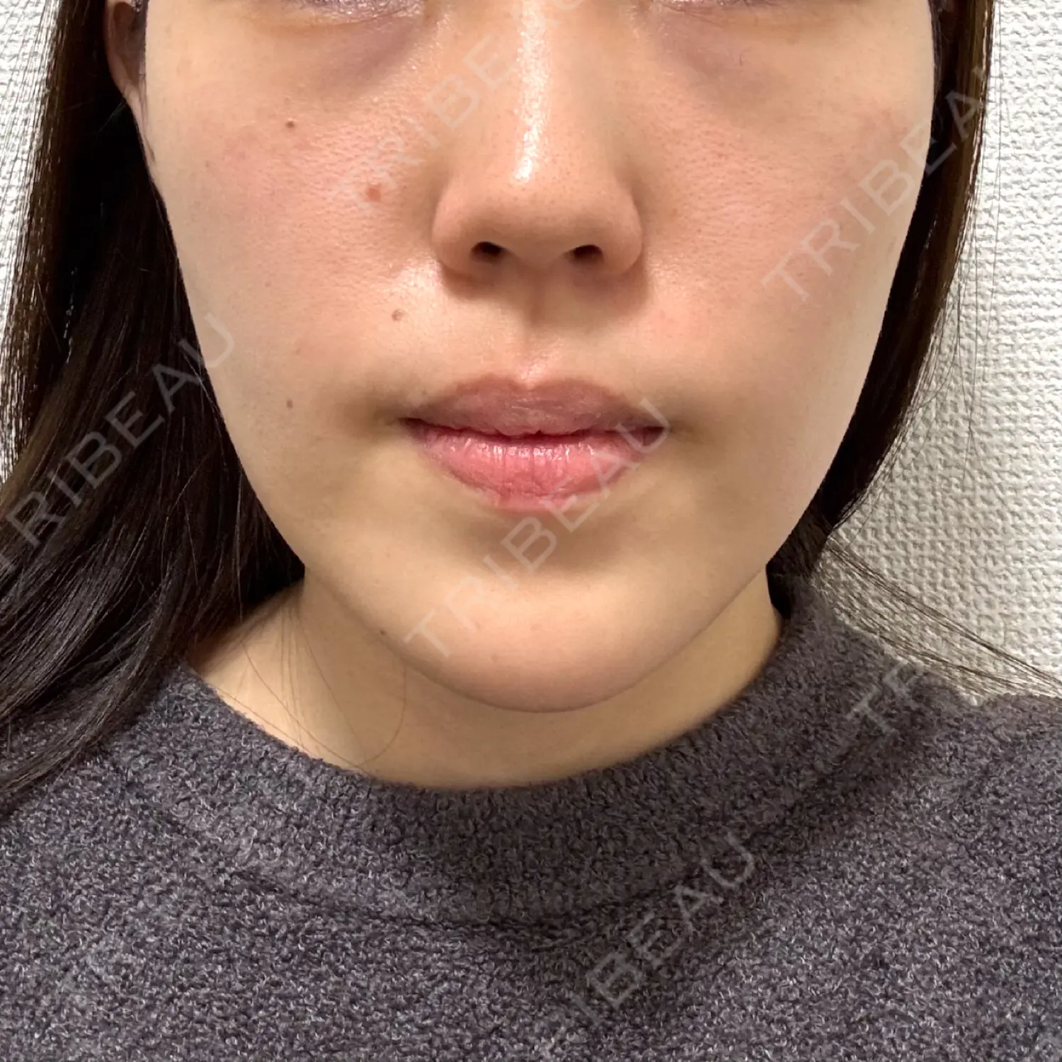 施術後の写真