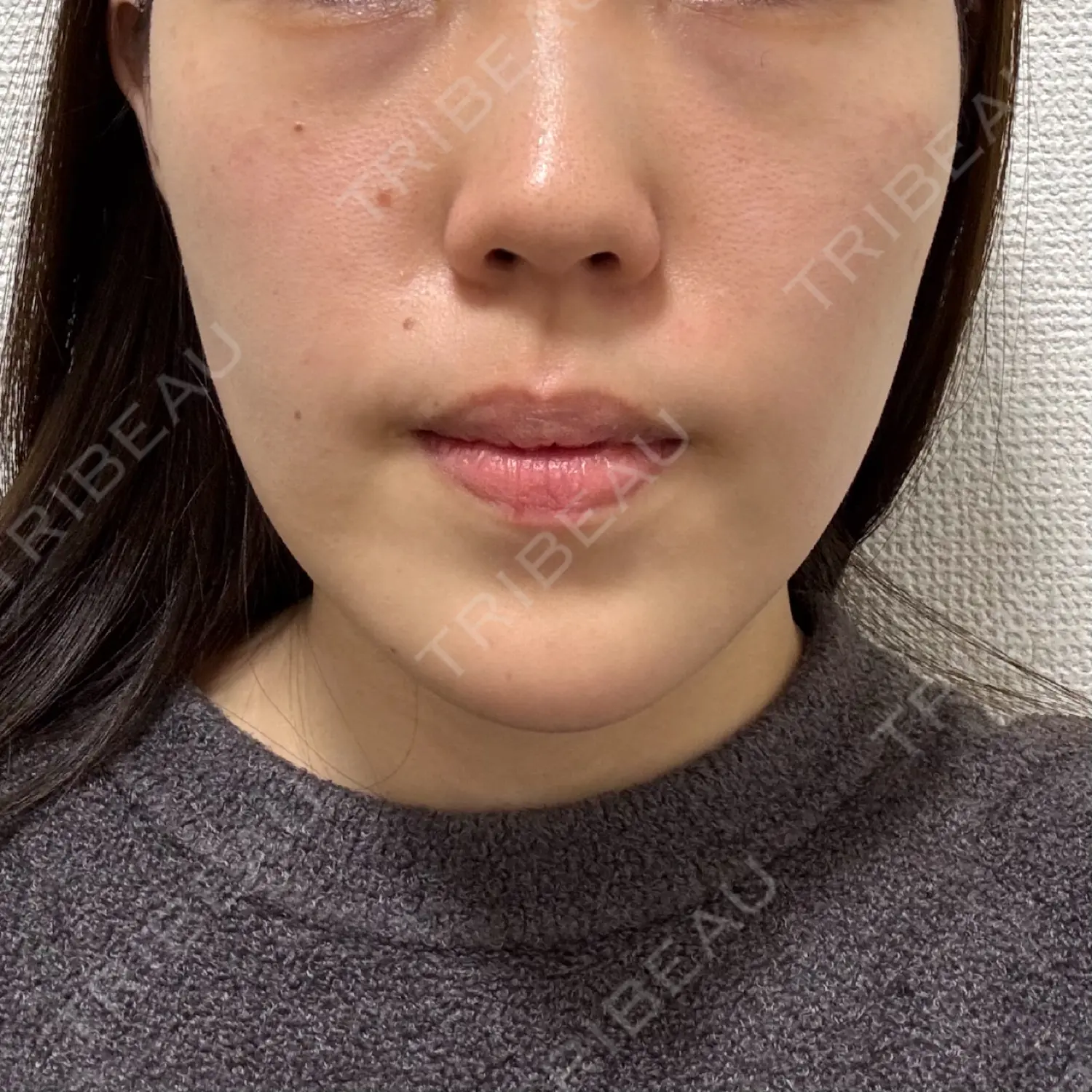 施術後の写真