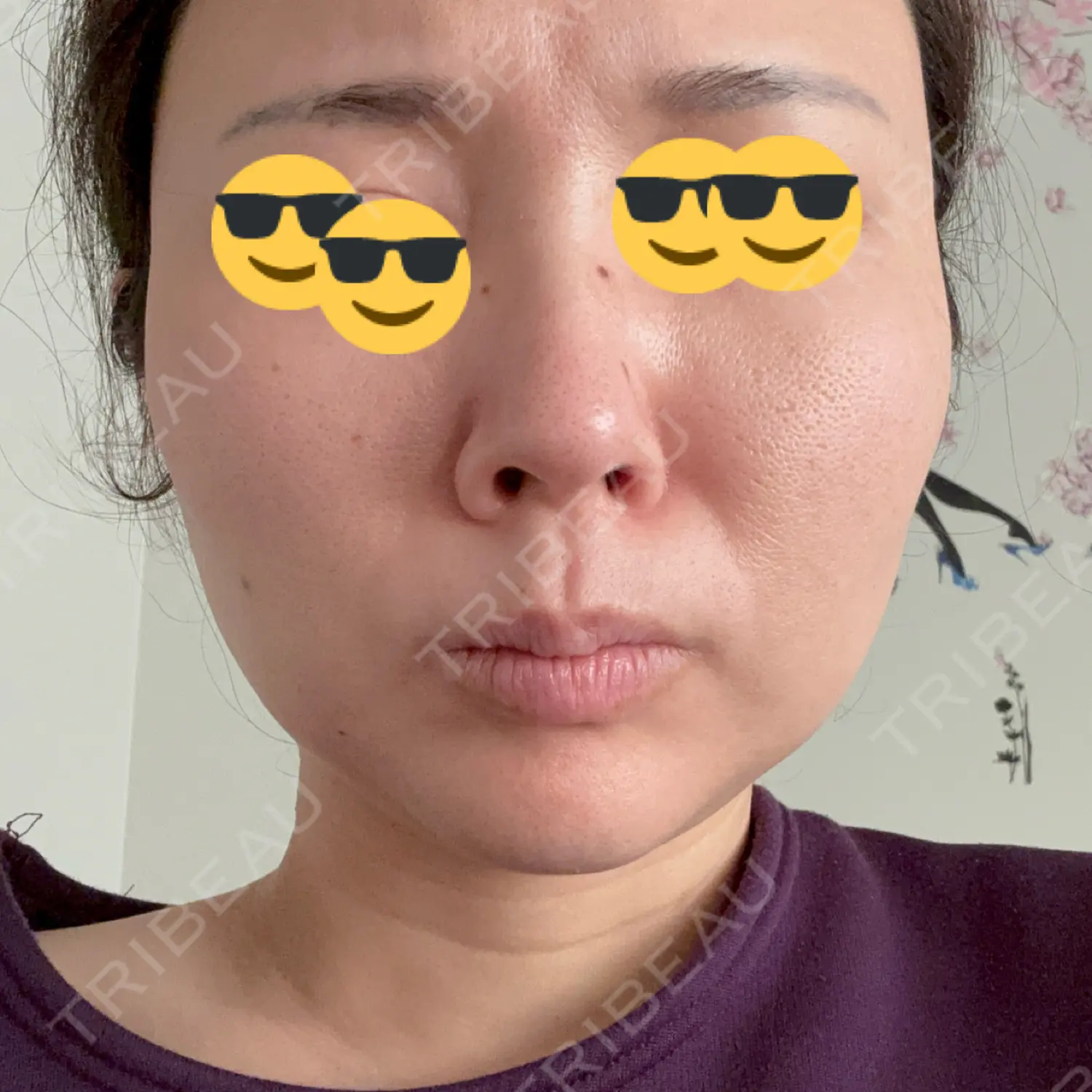 施術後の写真