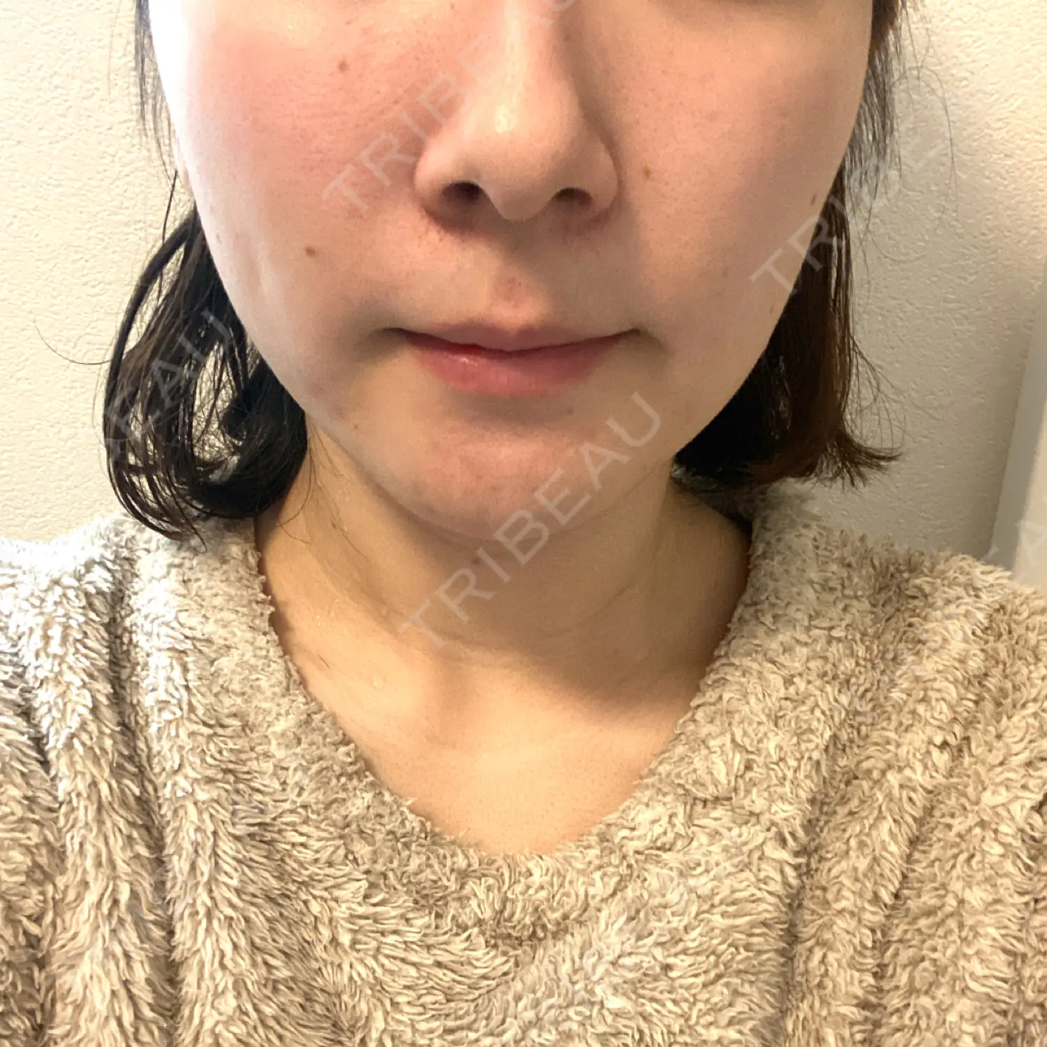 施術後の写真