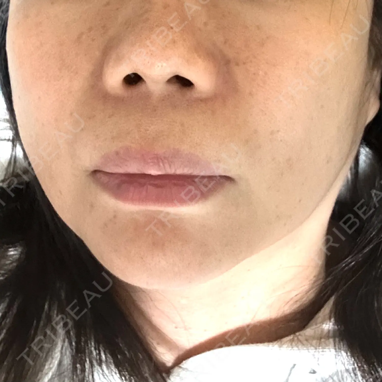 施術後の写真