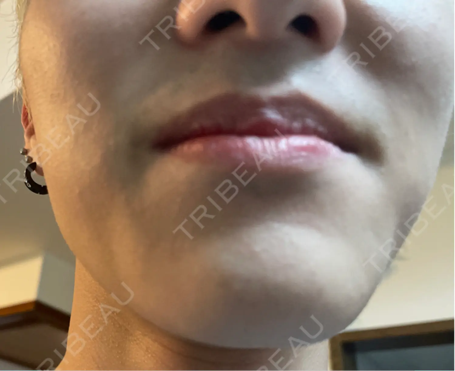 施術後の写真