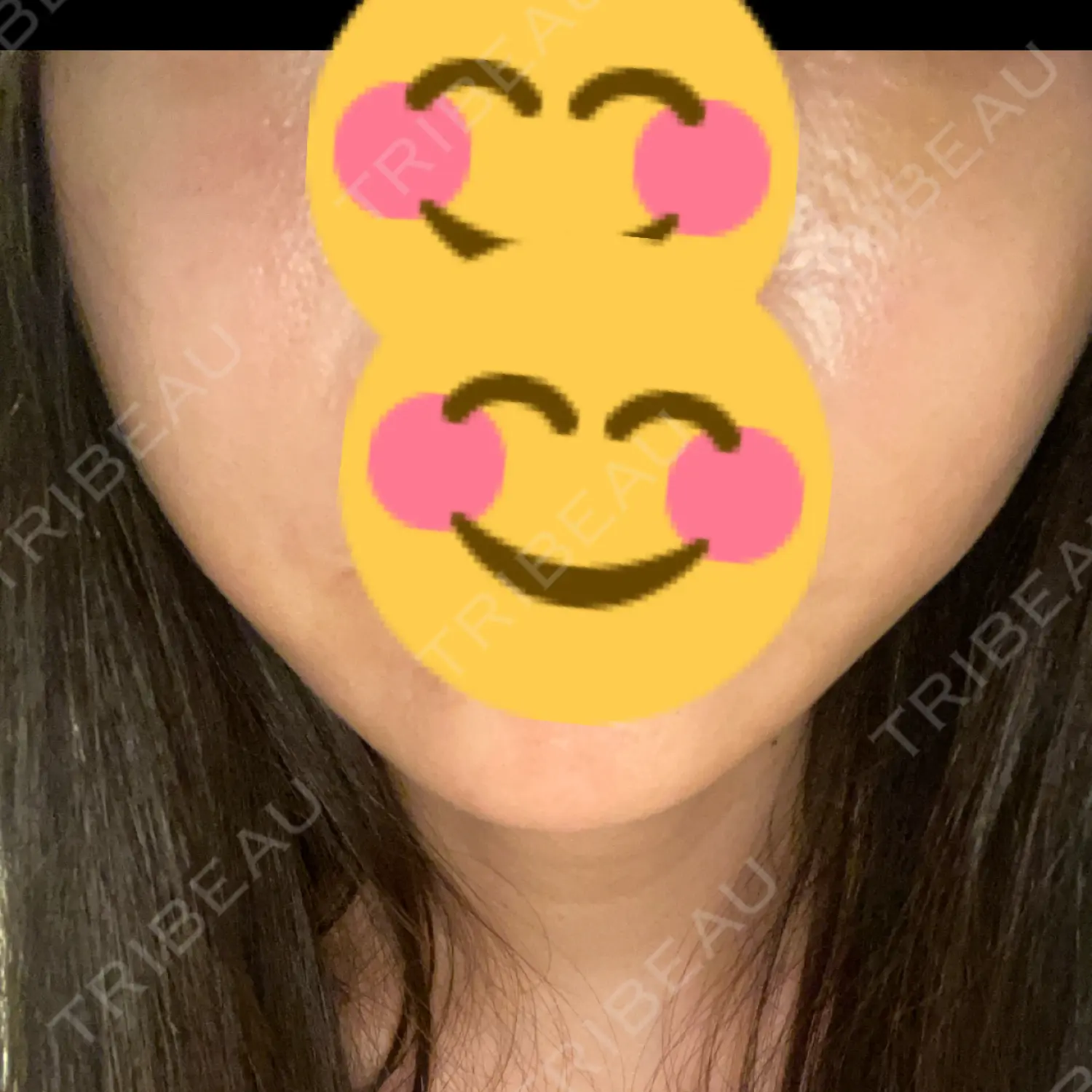 施術後の写真