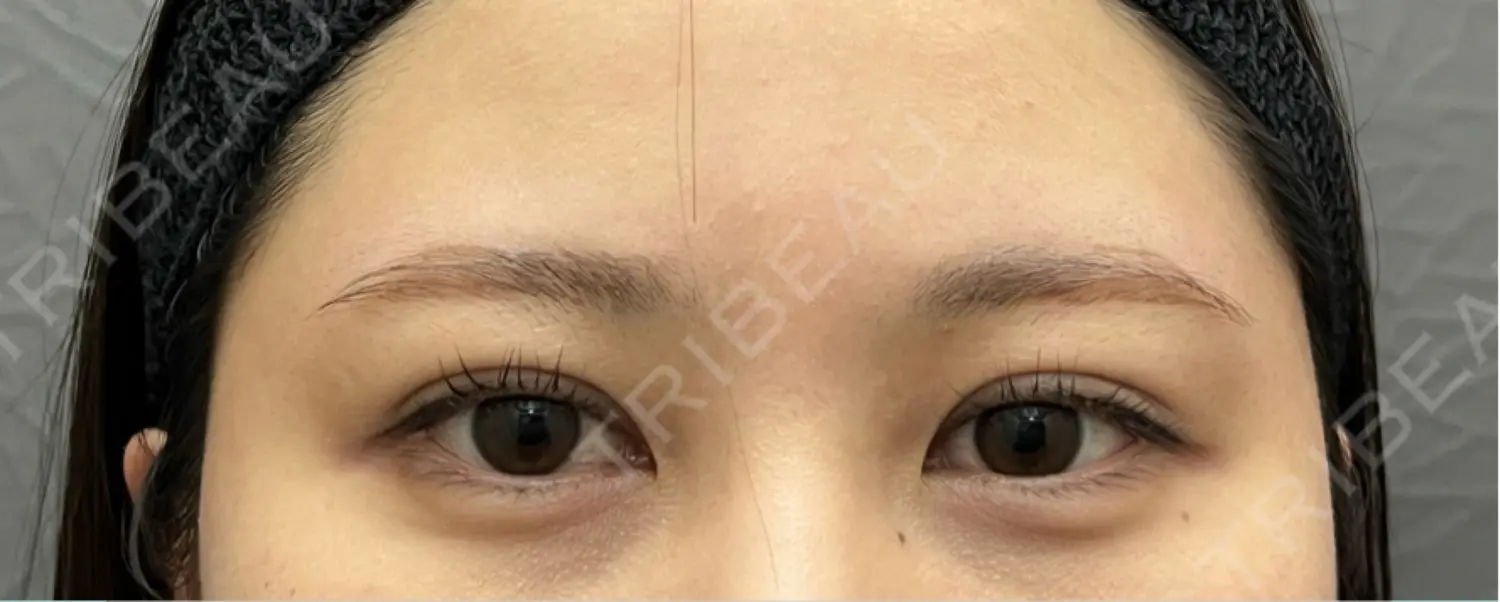 施術後の写真