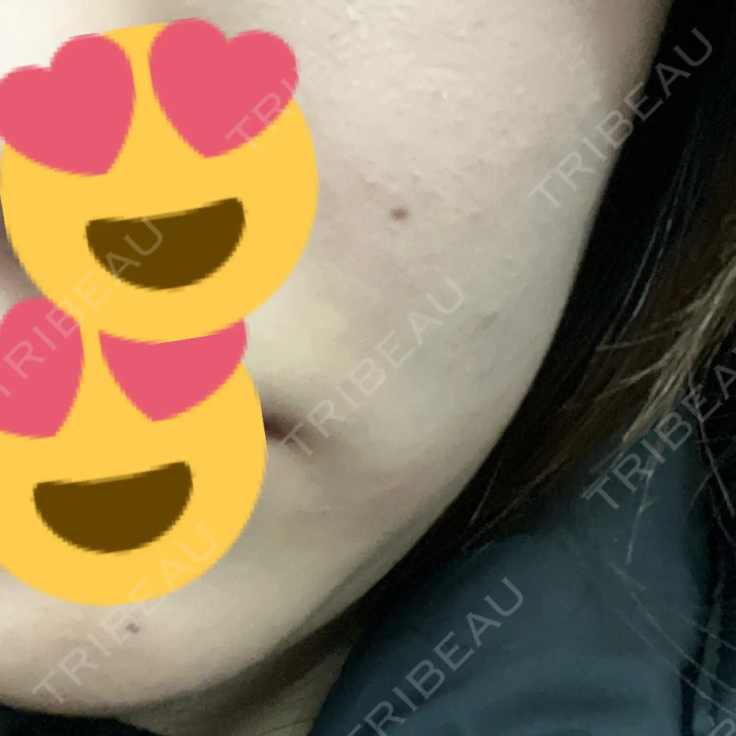 施術後の写真