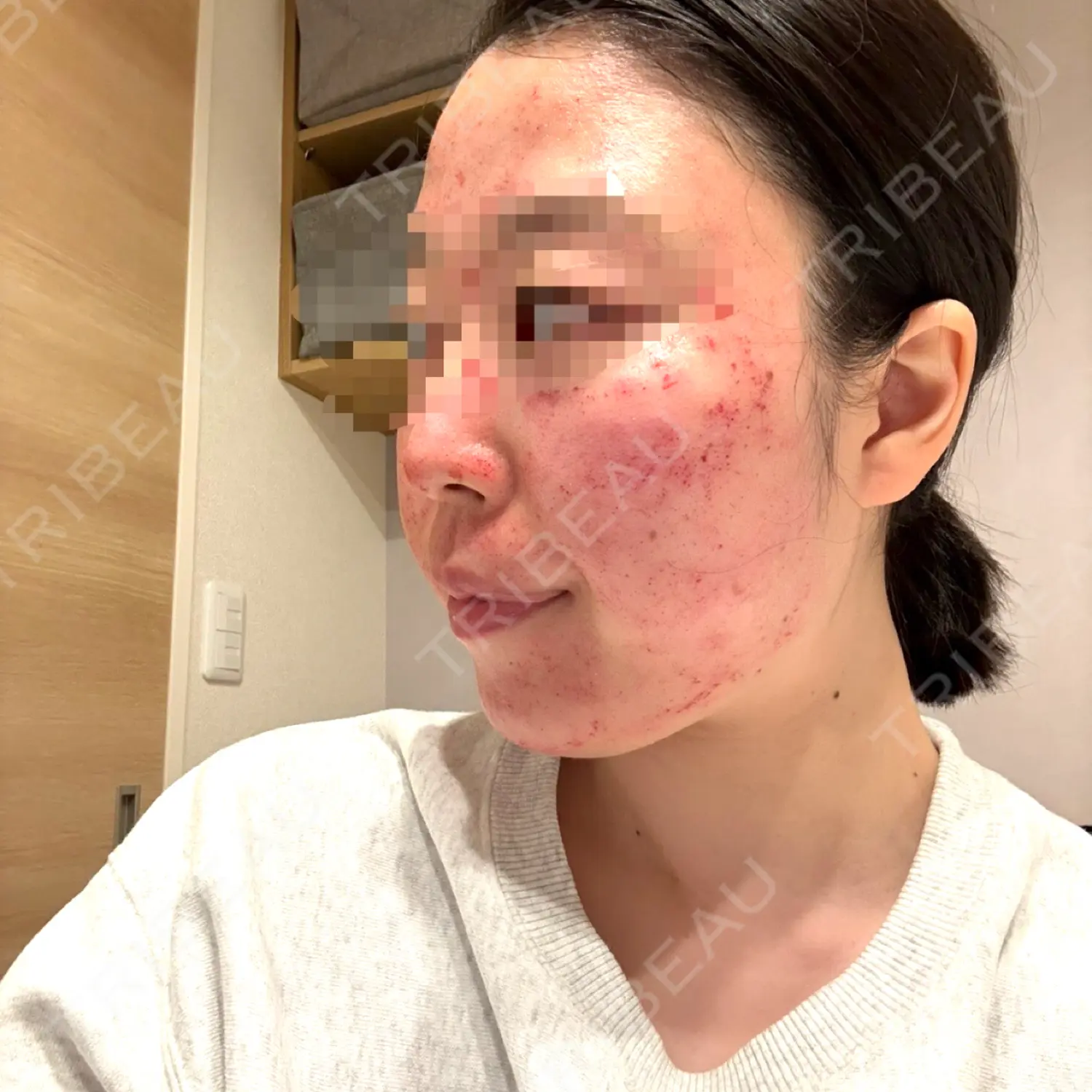 施術後の写真