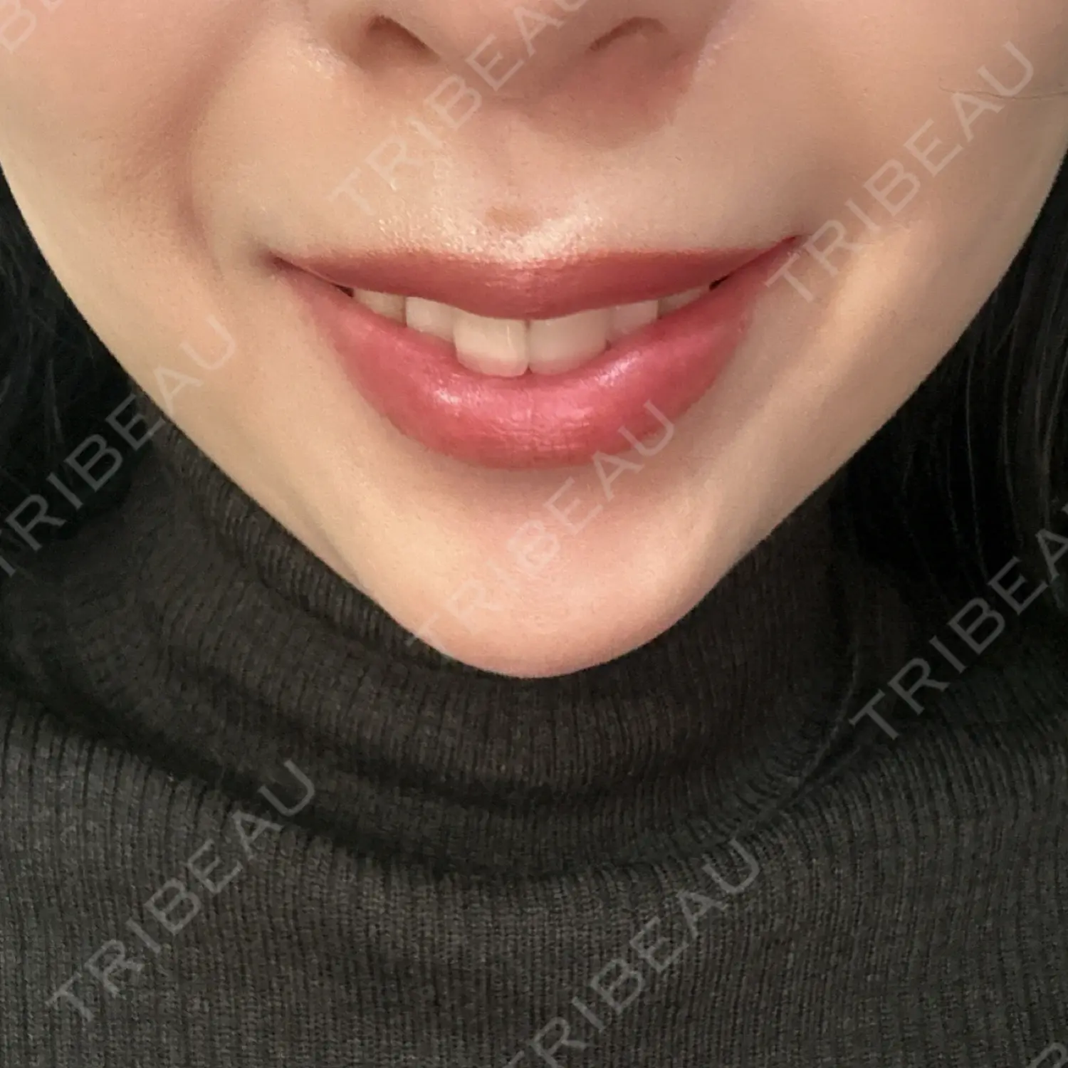 施術後の写真