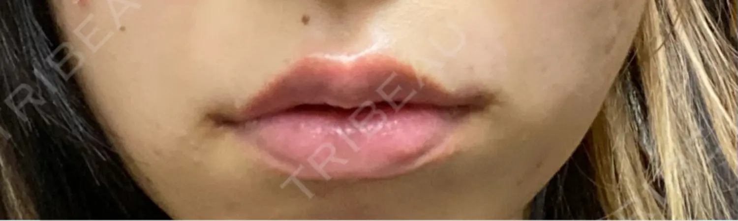 施術後の写真