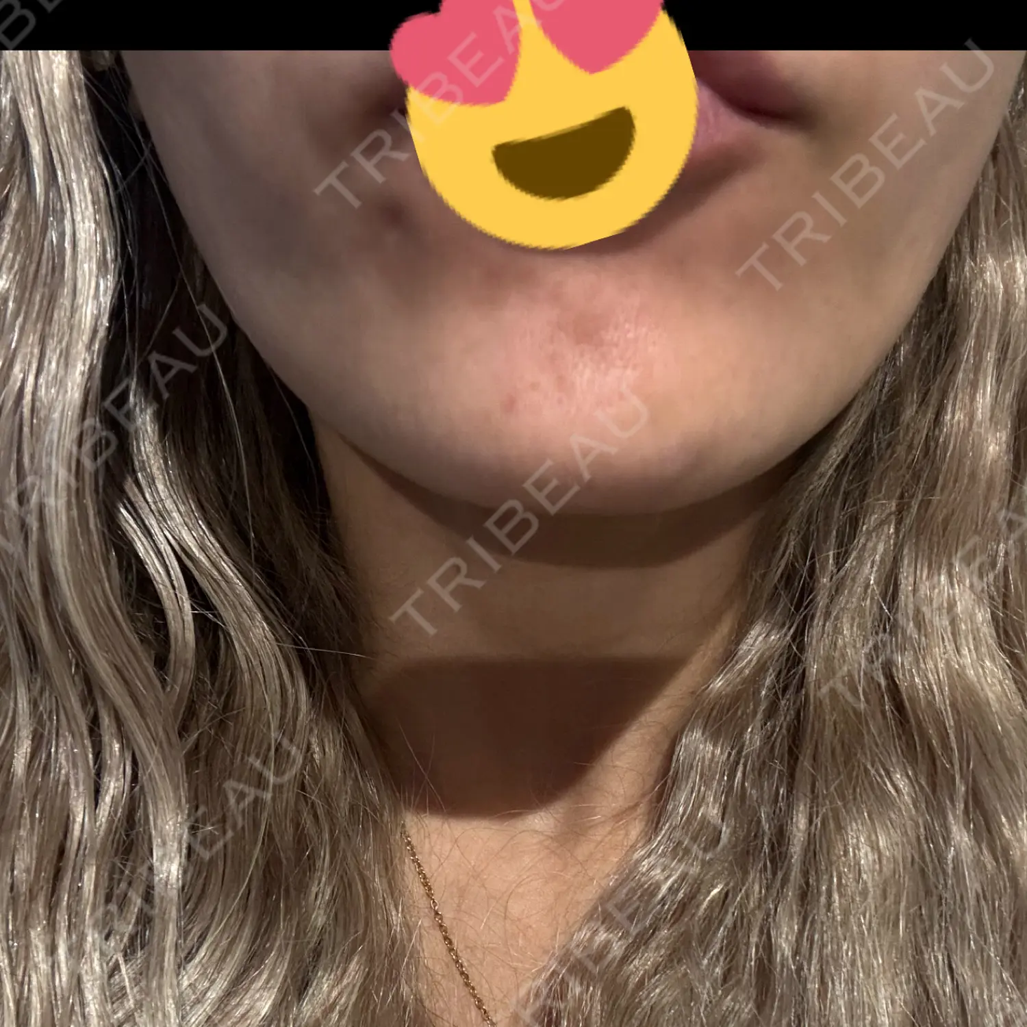施術後の写真