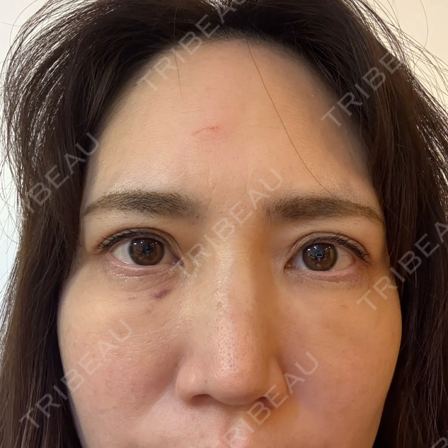 施術後の写真