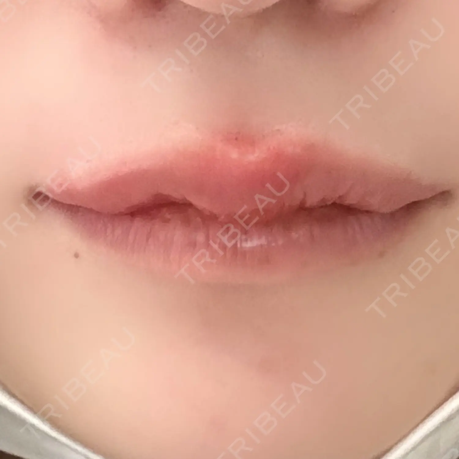 施術後の写真
