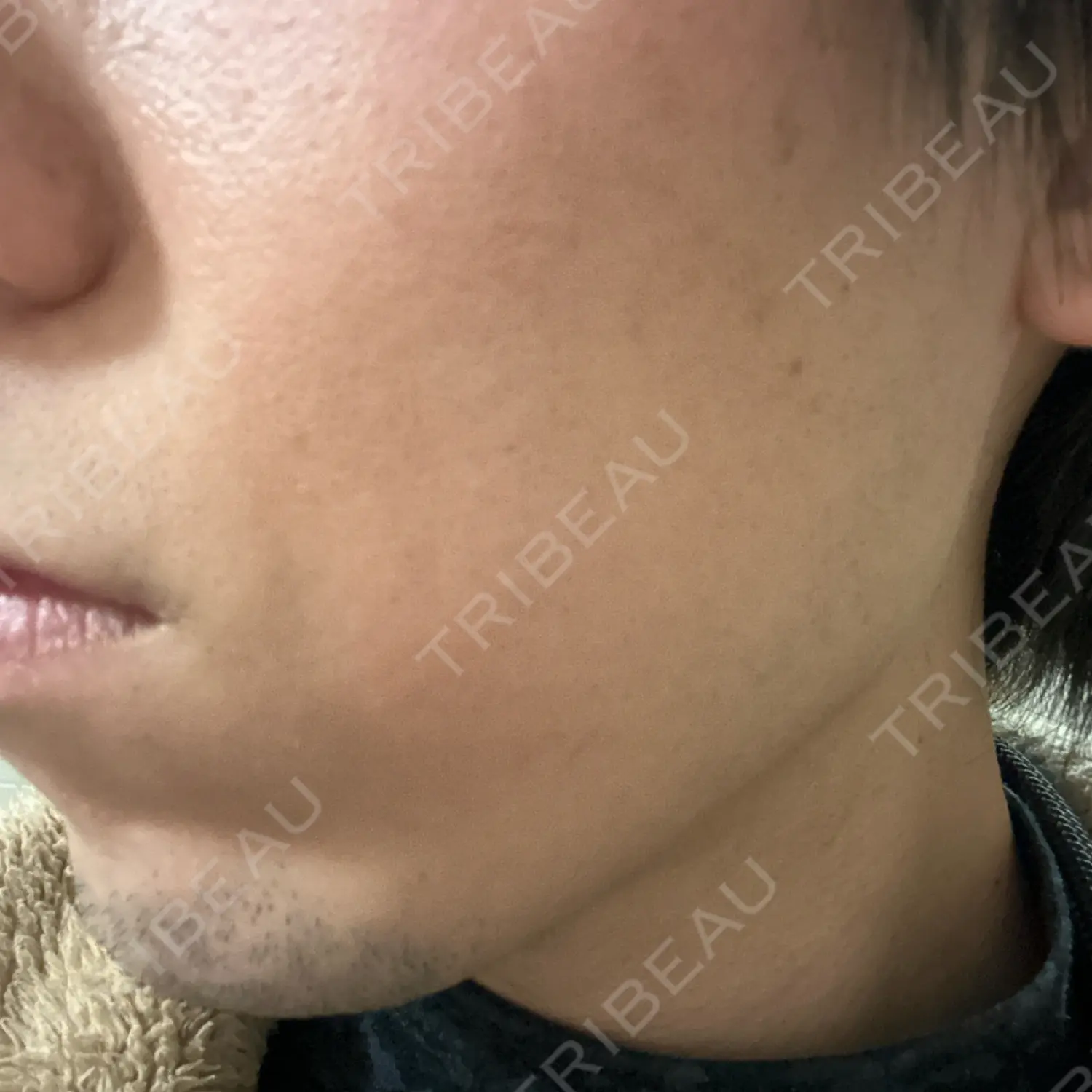 施術後の写真