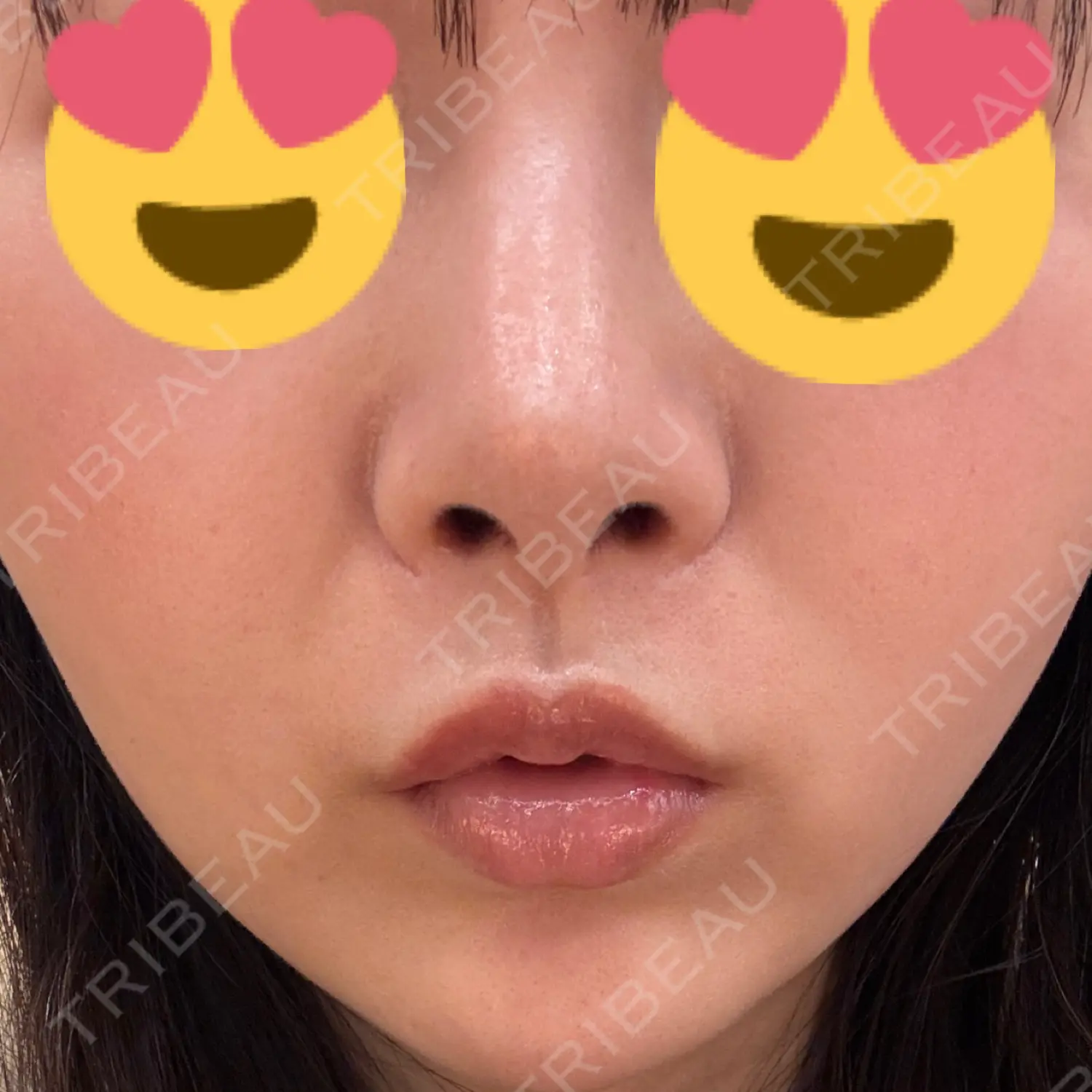 施術後の写真