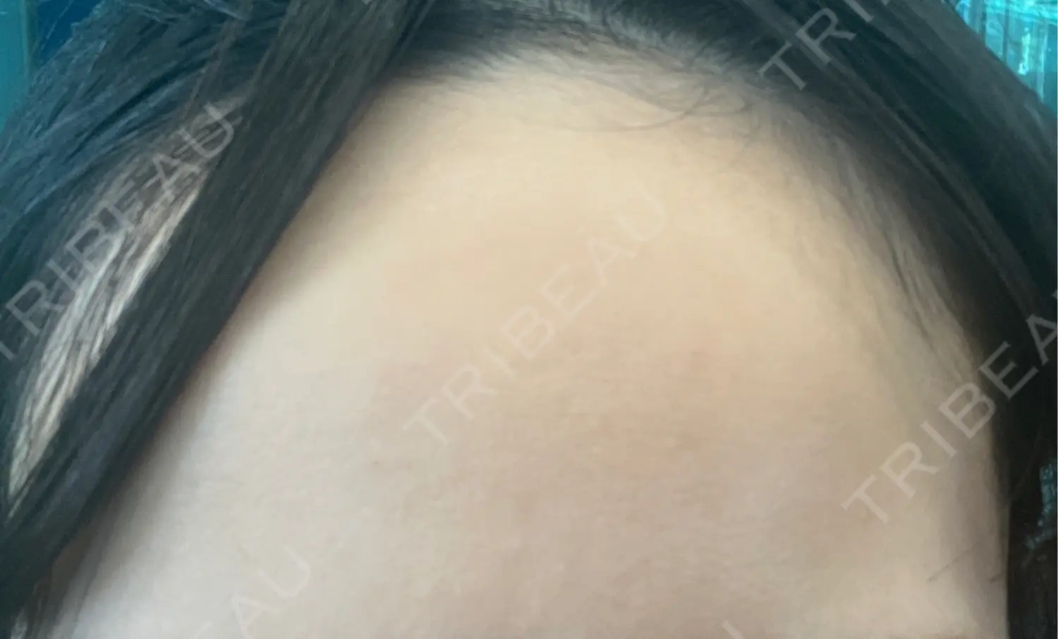 施術後の写真