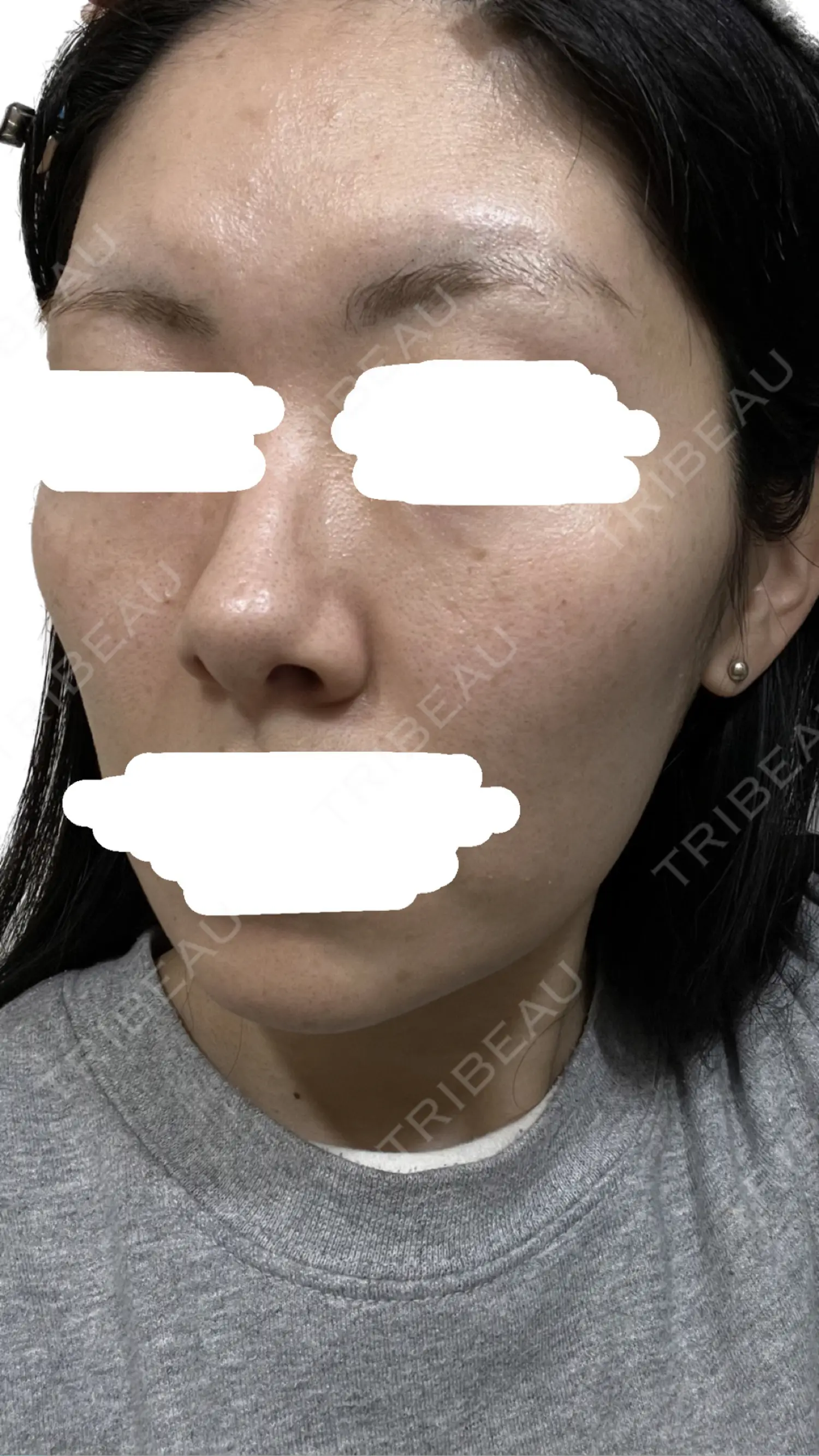 施術後の写真