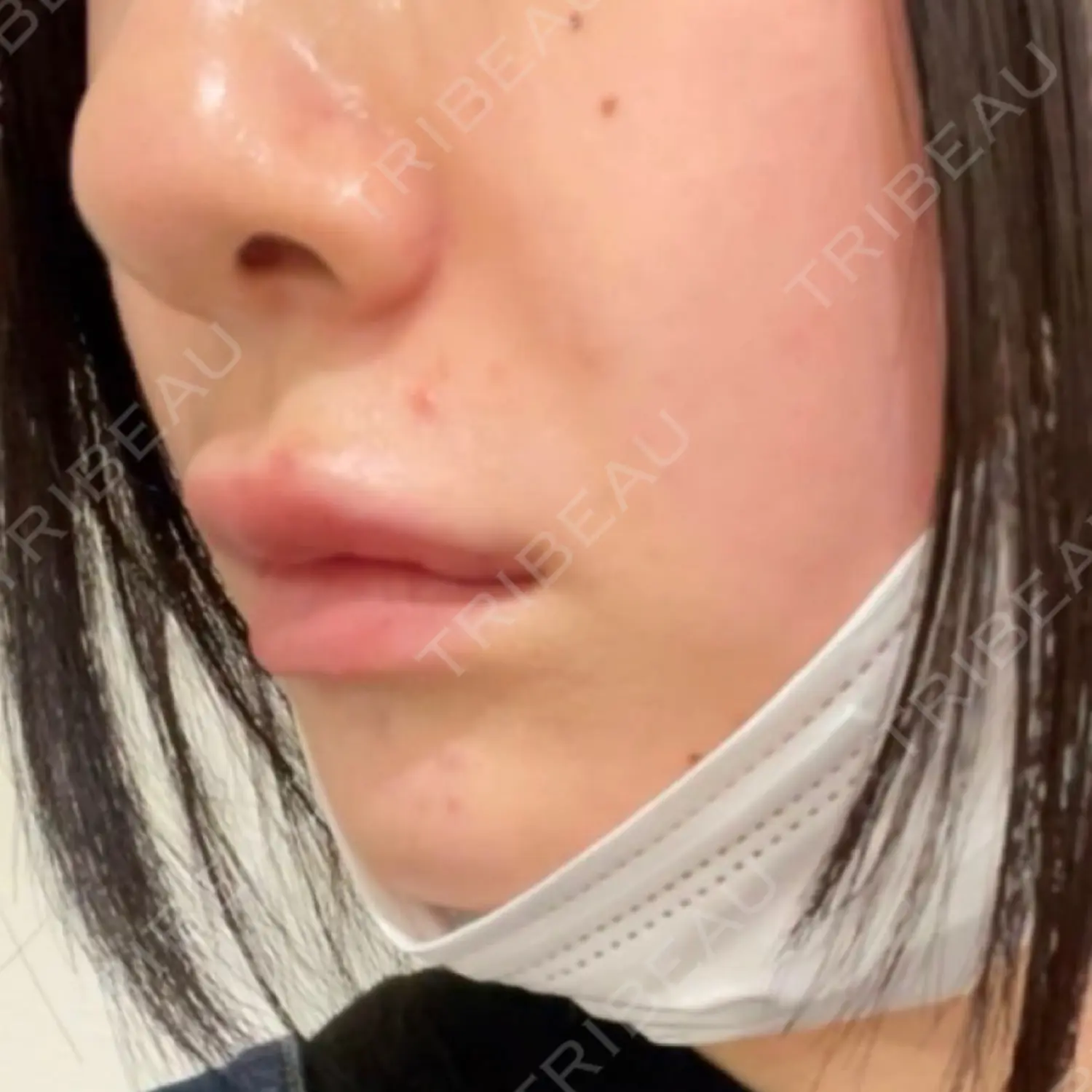 施術後の写真