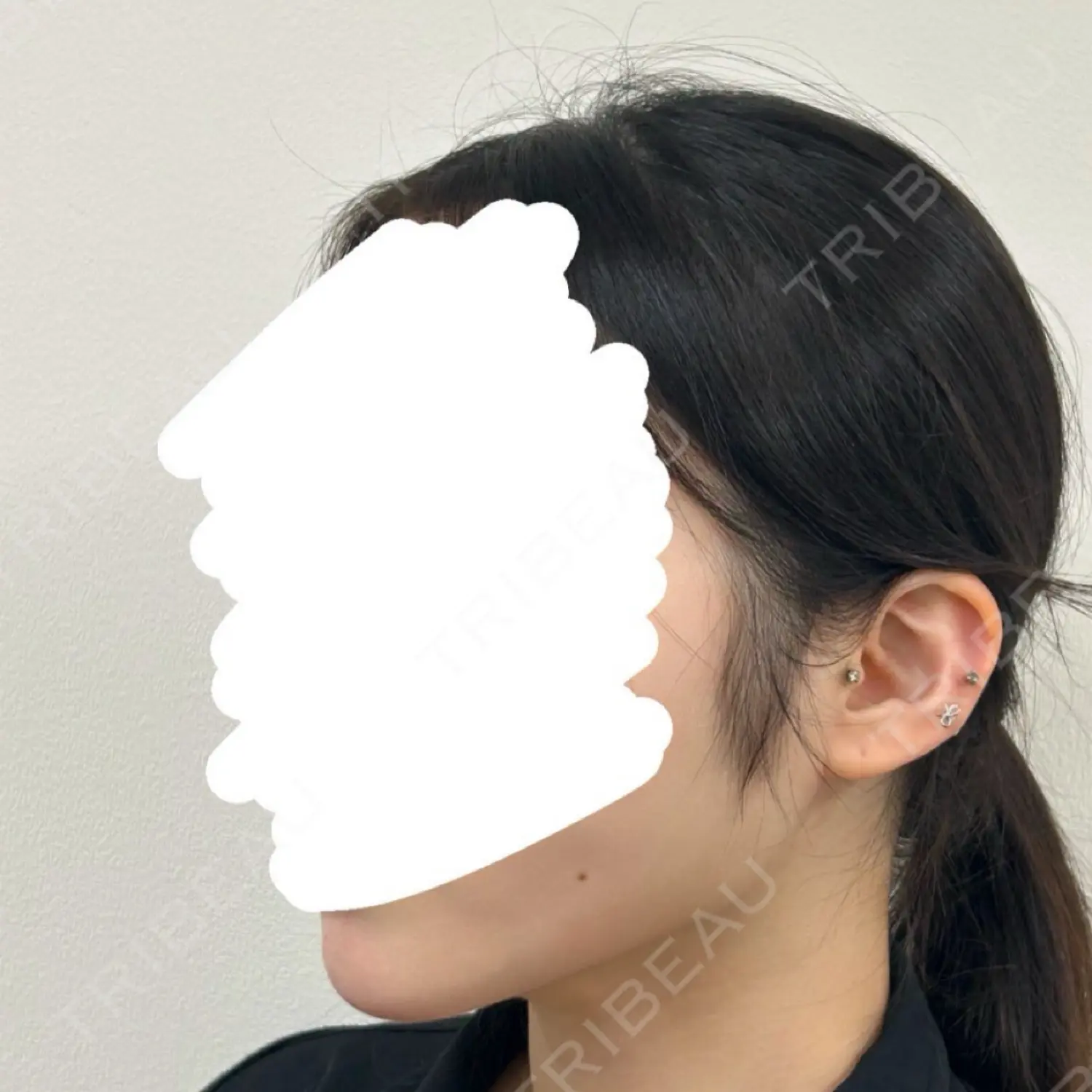 施術後の写真