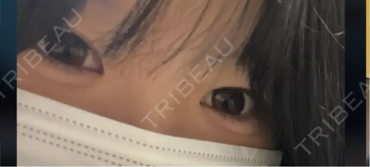 施術後の写真