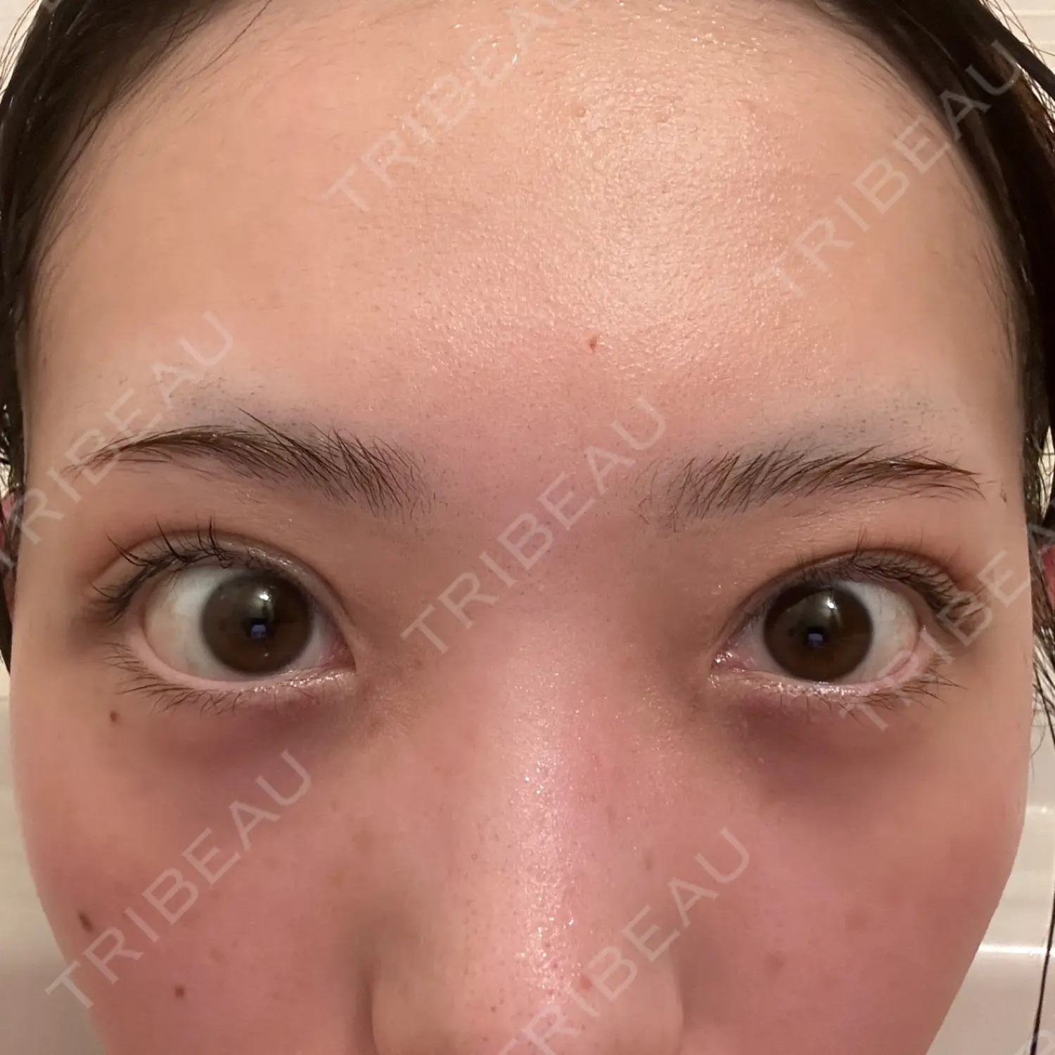 施術後の写真