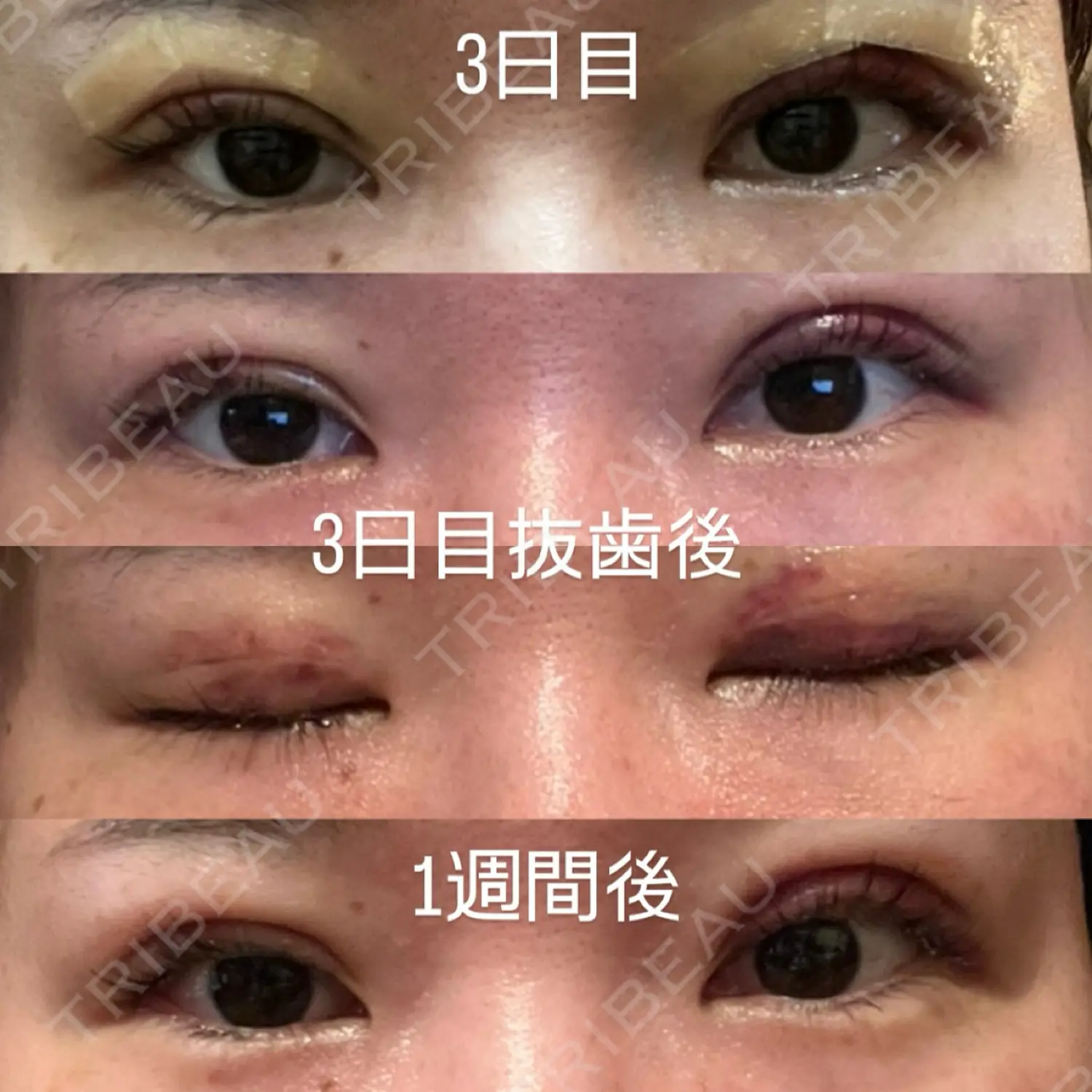 施術後の写真