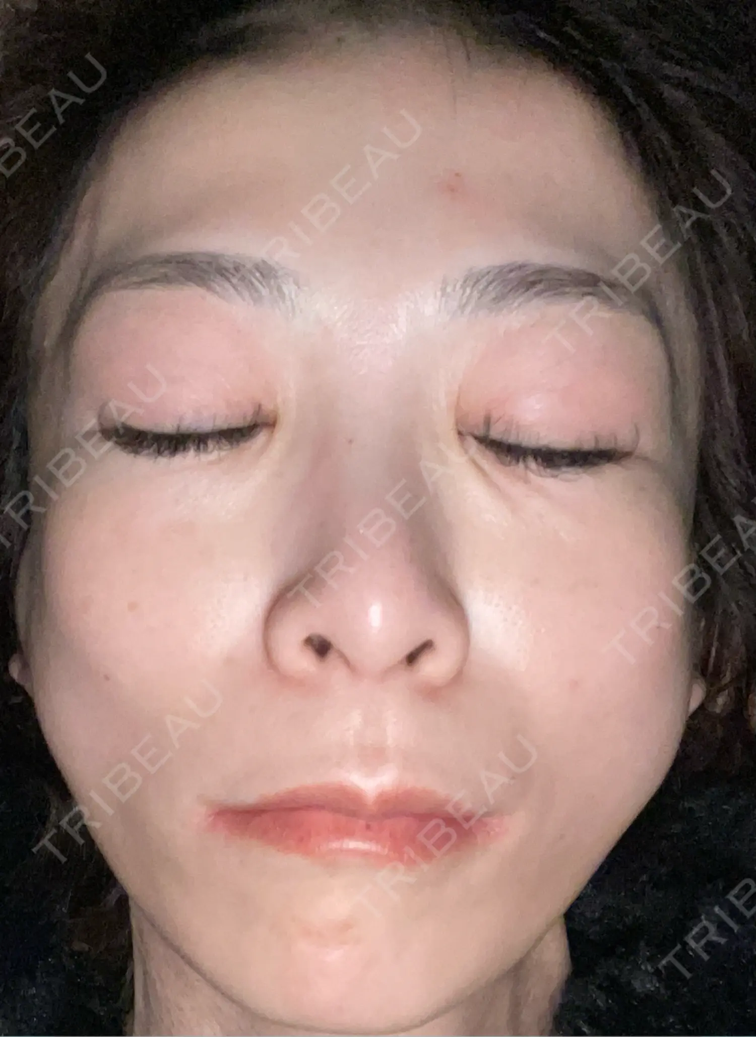 施術後の写真