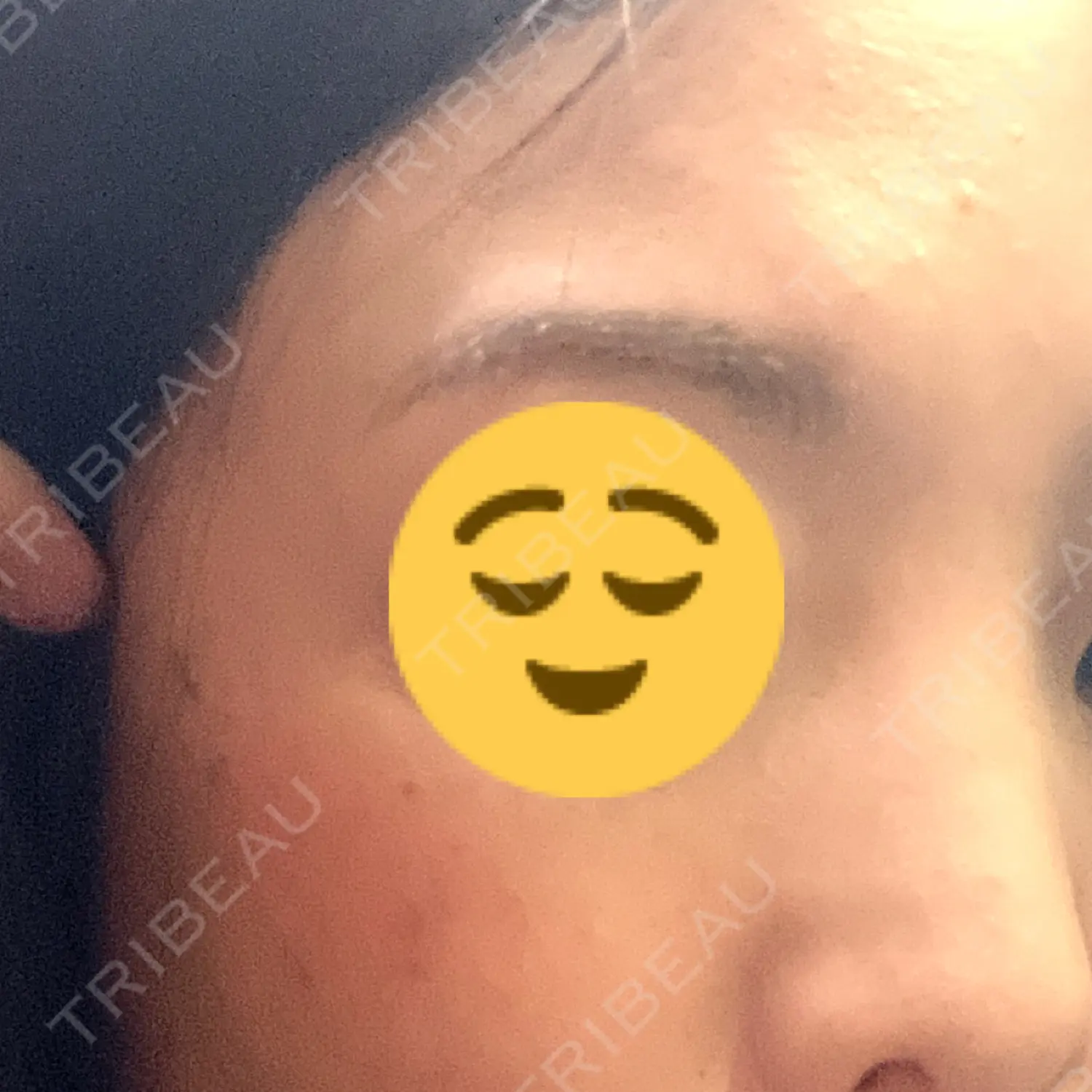 施術後の写真