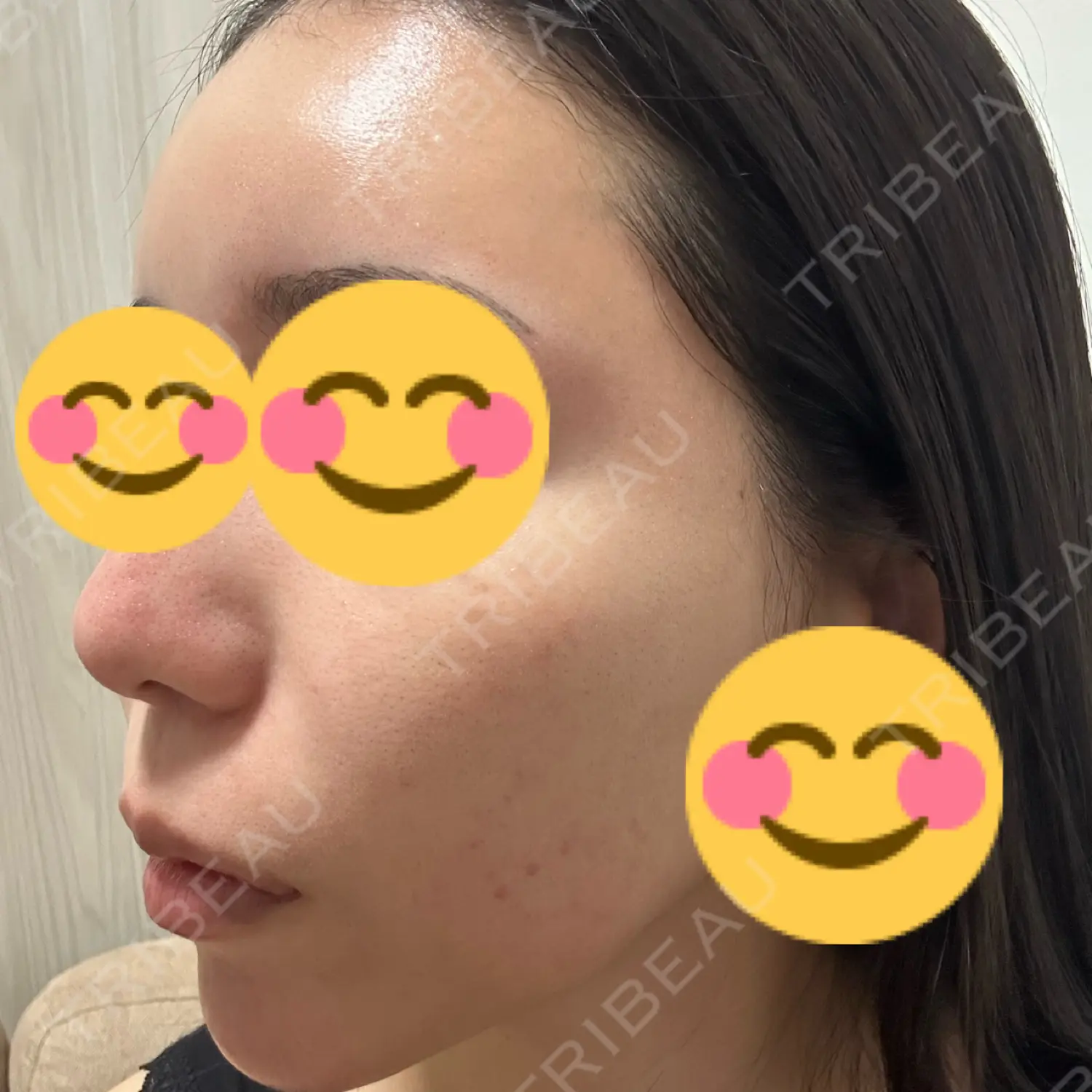 施術後の写真