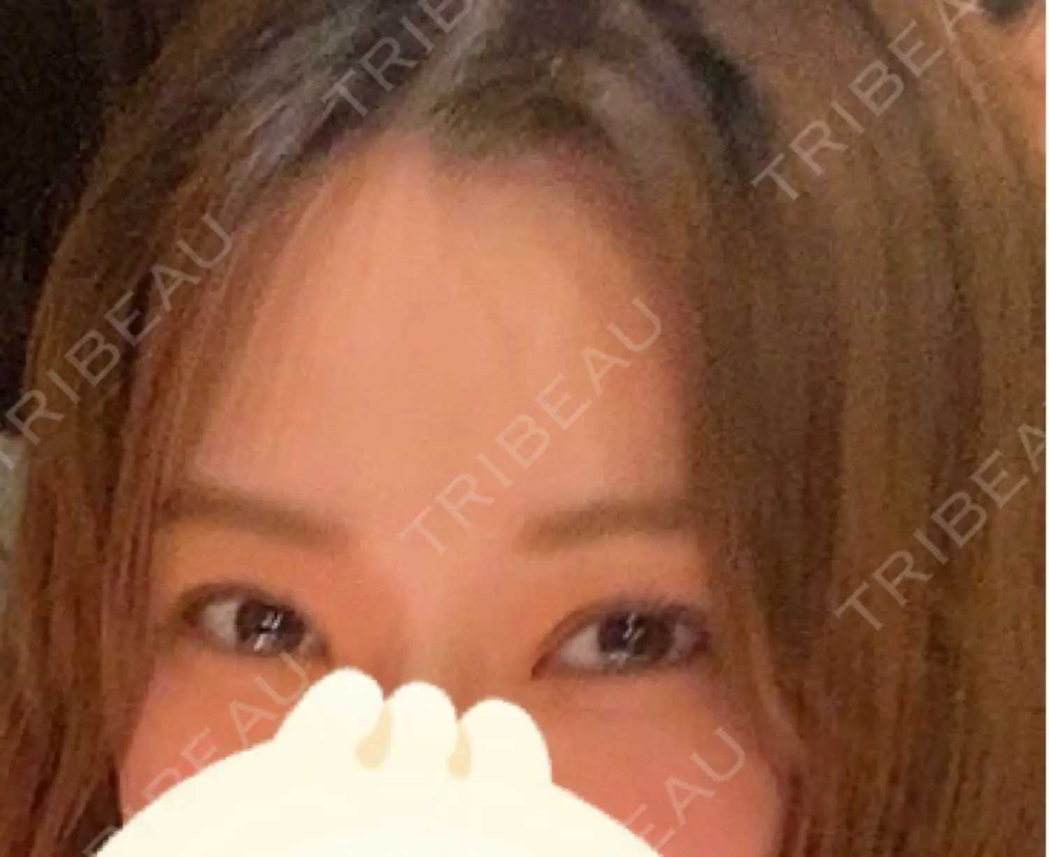 施術後の写真