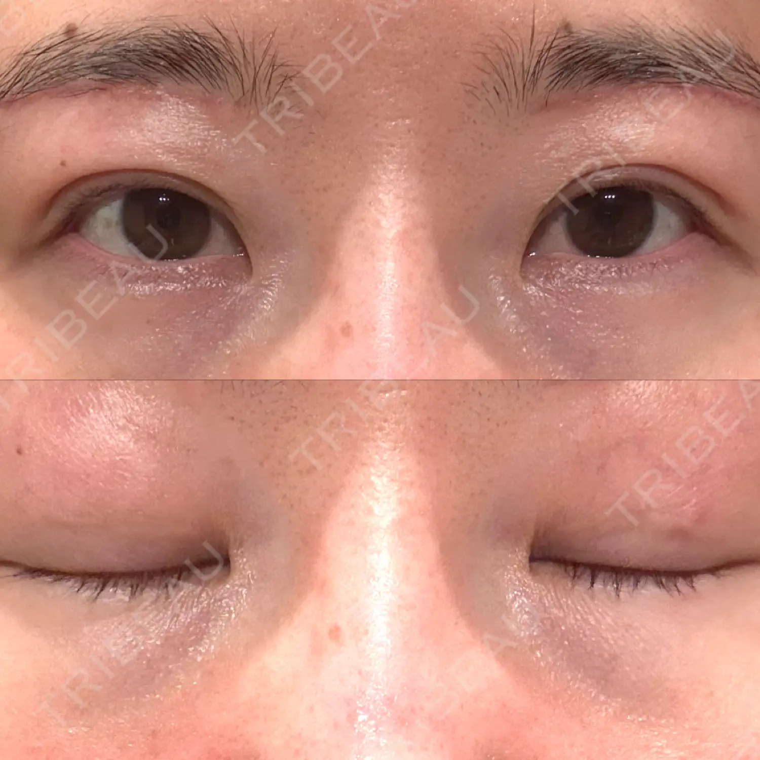 施術後の写真