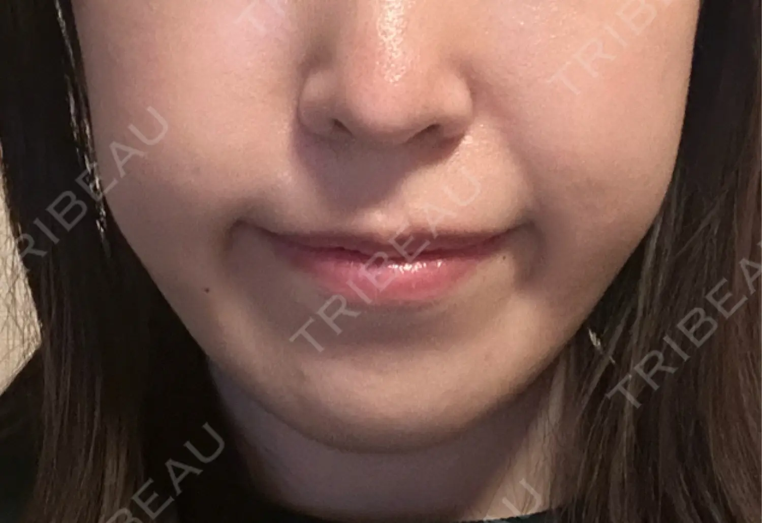 施術後の写真