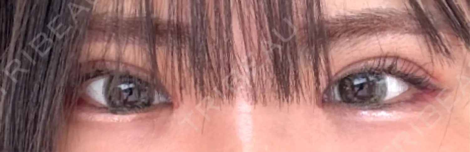 施術後の写真