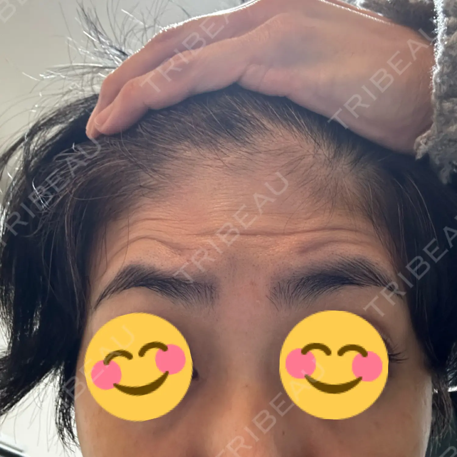 施術後の写真
